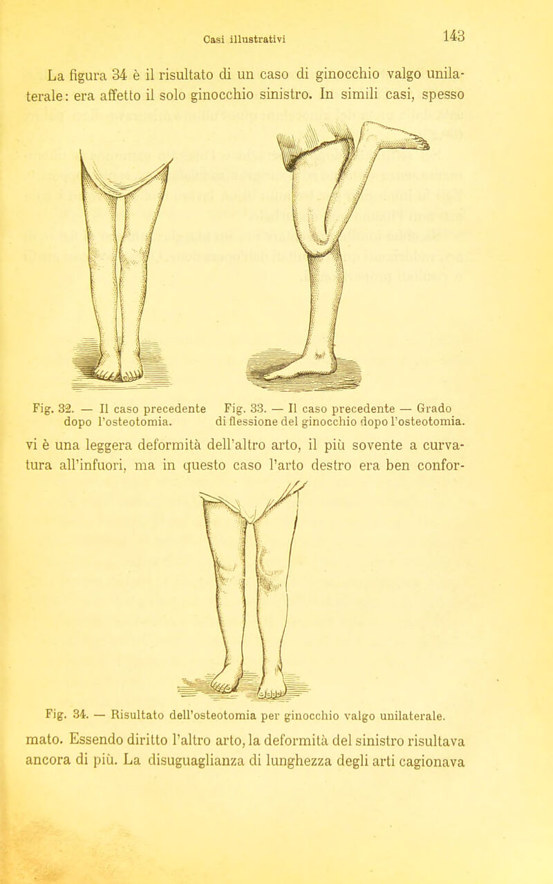 La figura 34 è il risultato di un caso di ginocchio valgo unila- terale: era affetto il solo ginocchio sinistro. In simili casi, spesso Fig. 32. — Il caso precedente Fig. 33. — Il caso precedente — Grado dopo l'osteotomia. di flessione del ginocchio dopo l'osteotomia. vi è una leggera deformità dell'altro arto, il più sovente a curva- tura all'infuori, ma in questo caso l'arto destro era ben confor- Fig. 34. — Risultato dell'osteotomia per ginocchio valgo unilaterale. mato. Essendo diritto l'altro arto, la deformità del sinistro risultava ancora di più. La disuguaglianza di lunghezza degli arti cagionava