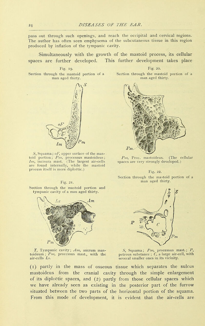 pass out through such openings, and reach the occipital and cervical regions. The author has often seen emphysema of the subcutaneous tissue in this region produced by inflation of the tympanic cavity. Simultaneously with the growth of the mastoid process, its cellular spaces are further developed. This further development takes place Fig. 19. Fig. 20. Section through the mastoid portion of a Section through the mastoid portion of a man aged thirty. man aged thirty. S, Squama; oF, upper surface of the mas- . toid portion; Pm, processus mastoideus; Im, incisura mast. (The largest air-cells are found internally, while the mastoid process itself is more diploetic.) Section through the mastoid portion and tympanic cavity of a man aged thirty. T, Tympanic cavity; Am, antrum mas- toideum ; Pm, processus mast., with the air-cells Ls. Pm, Proc. mastoideus. (The cellula spaces are very strongly developed.) Section through the mastoid portion of man aged thirty. 5, Squama; Pm, processus mast.; P, petrous substance ; C, a large air-cell, with several smaller ones in its vicinity. (1) partly in the mass of osseous tissue which separates the sulcus mastoideus from the cranial cavity through the simple enlargement of its diploetic spaces, and (2) partly from those cellular spaces which we have already seen as existing in the posterior part of the furrow situated between the two parts of the horizontal portion of the squama. From this mode of development, it is evident that the air-cells are