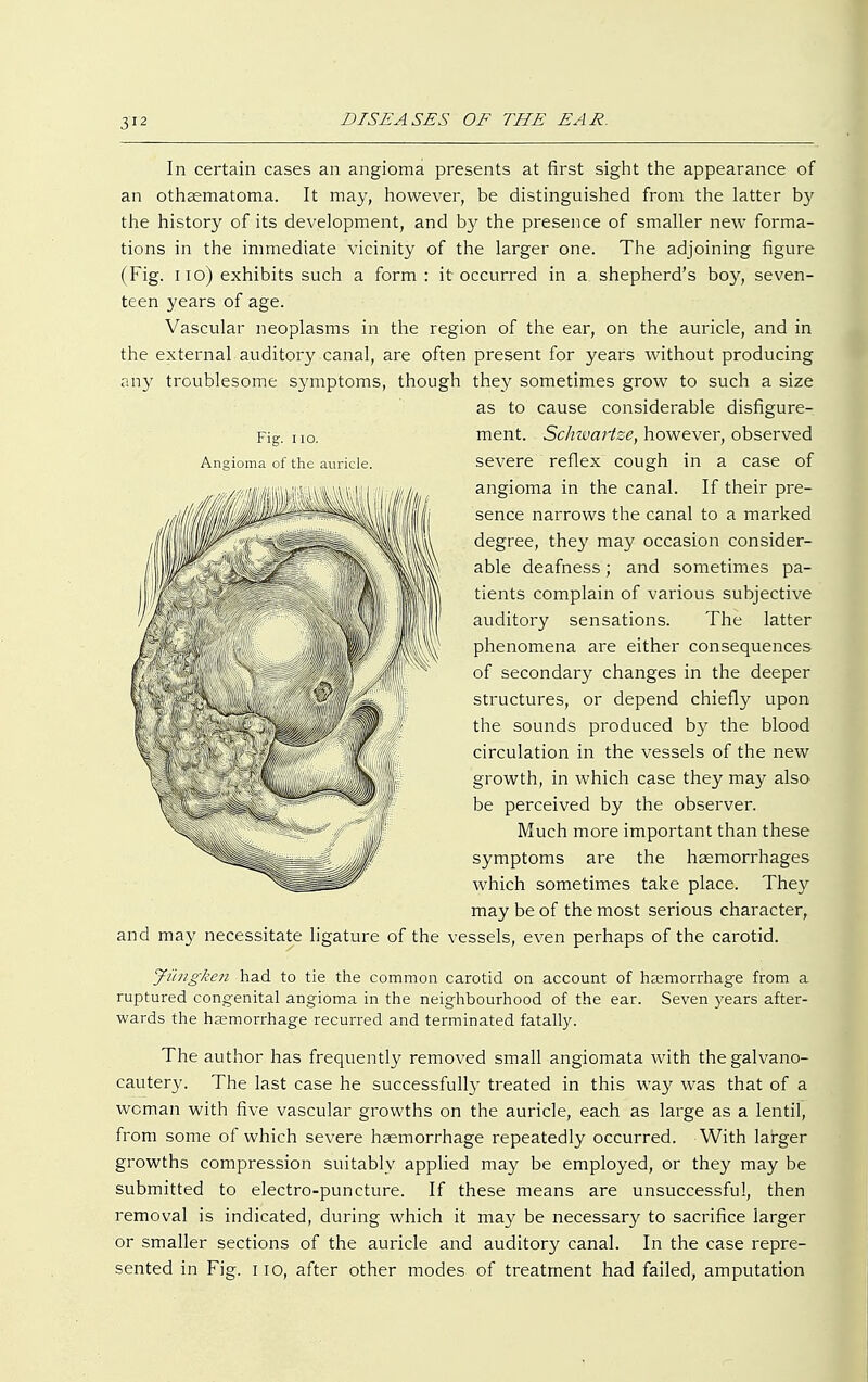 In certain cases an angioma presents at first sight the appearance of an othaematoma. It may, however, be distinguished from the latter by the history of its development, and by the presence of smaller new forma- tions in the immediate vicinity of the larger one. The adjoining figure (Fig. 11 o) exhibits such a form: it occurred in a shepherd's boy, seven- teen years of age. Vascular neoplasms in the region of the ear, on the auricle, and in the external auditory canal, are often present for years without producing any troublesome symptoms, though they sometimes grow to such a size as to cause considerable disfigure- Fig. no. Angioma of the auricle. ment. Schwartze, however, observed severe reflex cough in a case of angioma in the canal. If their pre- sence narrows the canal to a marked degree, they may occasion consider- able deafness; and sometimes pa- tients complain of various subjective auditory sensations. The latter phenomena are either consequences of secondary changes in the deeper structures, or depend chiefly upon the sounds produced by the blood circulation in the vessels of the new growth, in which case they may also be perceived by the observer. Much more important than these symptoms are the haemorrhages which sometimes take place. They may be of the most serious character, and may necessitate ligature of the vessels, even perhaps of the carotid. Jiingken had to tie the common carotid on account of haemorrhage from a ruptured congenital angioma in the neighbourhood of the ear. Seven years after- wards the haemorrhage recurred and terminated fatally. The author has frequently removed small angiomata with thegalvano- cautery. The last case he successfully treated in this way was that of a woman with five vascular growths on the auricle, each as large as a lentil, from some of which severe haemorrhage repeatedly occurred. With larger growths compression suitably applied may be employed, or they may be submitted to electro-puncture. If these means are unsuccessful, then removal is indicated, during which it may be necessary to sacrifice larger or smaller sections of the auricle and auditory canal. In the case repre- sented in Fig. 110, after other modes of treatment had failed, amputation