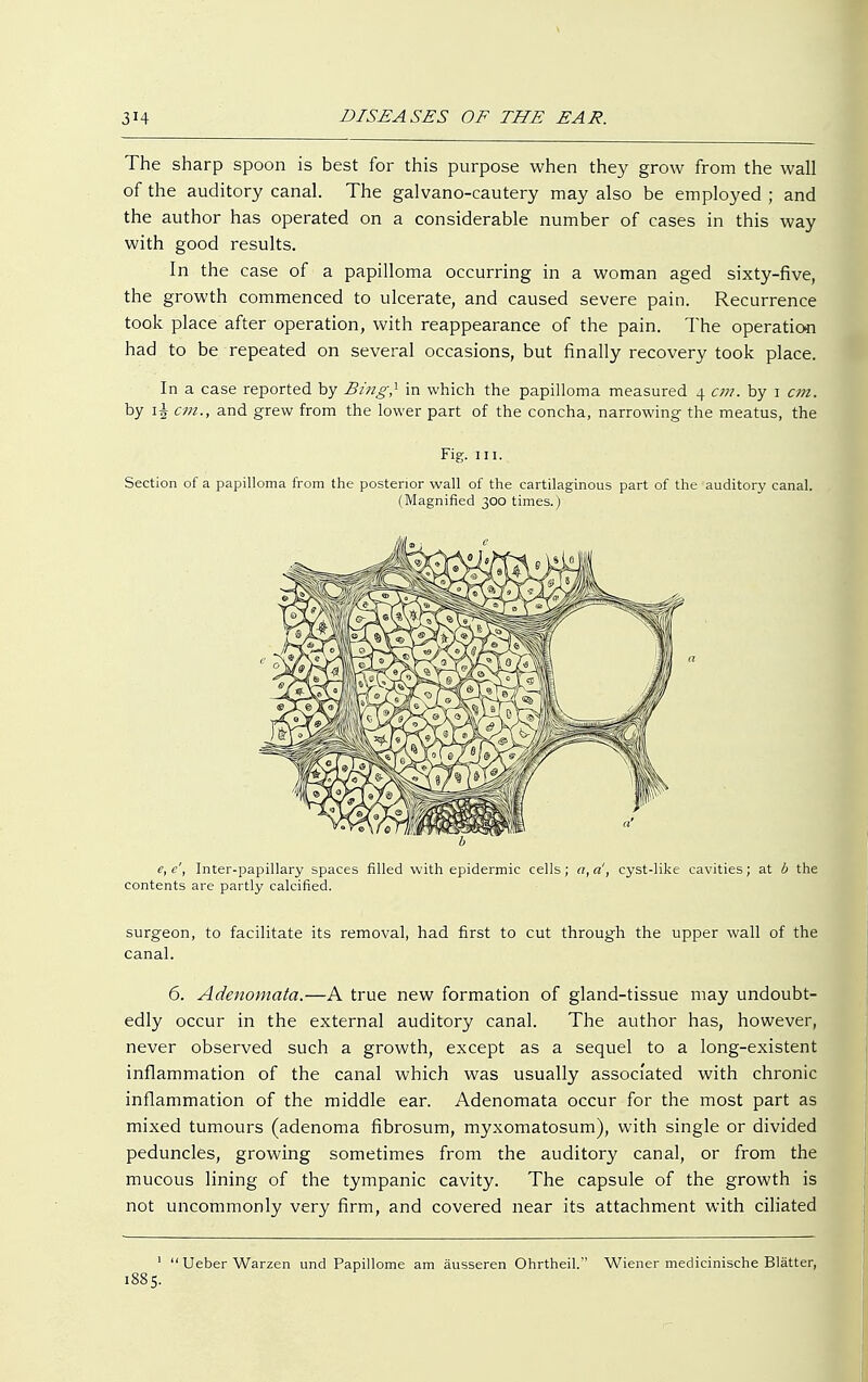 The sharp spoon is best for this purpose when they grow from the wall of the auditory canal. The galvano-cautery may also be employed ; and the author has operated on a considerable number of cases in this way with good results. In the case of a papilloma occurring in a woman aged sixty-five, the growth commenced to ulcerate, and caused severe pain. Recurrence took place after operation, with reappearance of the pain. The operation had to be repeated on several occasions, but finally recovery took place. In a case reported by Bing,1 in which the papilloma measured 4 cm. by 1 cm. by \\ cm., and grew from the lower part of the concha, narrowing the meatus, the Fig. 111. Section of a papilloma from the posterior wall of the cartilaginous part of the auditory canal. (Magnified 300 times.) e, c', Inter-papillary spaces filled with epidermic cells; a, a', cyst-like cavities; at b the contents are partly calcified. surgeon, to facilitate its removal, had first to cut through the upper wall of the canal. 6. Adenomata.—A true new formation of gland-tissue may undoubt- edly occur in the external auditory canal. The author has, however, never observed such a growth, except as a sequel to a long-existent inflammation of the canal which was usually associated with chronic inflammation of the middle ear. Adenomata occur for the most part as mixed tumours (adenoma fibrosum, myxomatosum), with single or divided peduncles, growing sometimes from the auditory canal, or from the mucous lining of the tympanic cavity. The capsule of the growth is not uncommonly very firm, and covered near its attachment with ciliated 1  Ueber Warzen und Papillome am äusseren Ohrtheil. Wiener medicinische Blätter, 1885.