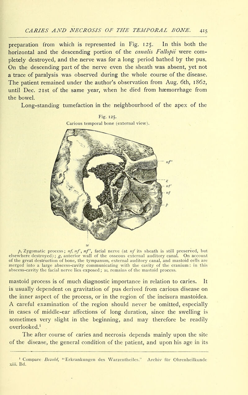 preparation from which is represented in Fig. 125. In this both the horizontal and the descending portion of the canalis Fallopii were com- pletely destroyed, and the nerve was for a long period bathed by the pus. On the descending part of the nerve even the sheath was absent, yet not a trace of paralysis was observed during the whole course of the disease. The patient remained under the author's observation from Aug. 6th, 1862, until Dec. 2ist of the same year, when he died from haemorrhage from the bowel. Long-standing tumefaction in the neighbourhood of the apex of the Fig. 125. Carious temporal bone (external view). p, Zygomatic process; nf.nf, nf, facial nerve (at nf its sheath is still preserved, but elsewhere destroyed); g, anterior wall of the osseous external auditory canal. On account of the great destruction of bone, the tympanum, external auditory canal, and mastoid cells are merged into a large abscess-cavity communicating with the cavity of the cranium: in this abscess-cavity the facial nerve lies exposed; zu, remains of the mastoid process. mastoid process is of much diagnostic importance in relation to caries. It is usually dependent on gravitation of pus derived from carious disease on the inner aspect of the process, or in the region of the incisura mastoidea. A careful examination of the region should never be omitted, especially in cases of middle-ear affections of long duration, since the swelling is sometimes very slight in the beginning, and may therefore be readily overlooked.1 The after course of caries and necrosis depends mainly upon the site of the disease, the general condition of the patient, and upon his age in its 1 Compare Bczold, Erkrankungen des Warzentheiles. Archiv für Ohrenheilkunde xiii. Bd.