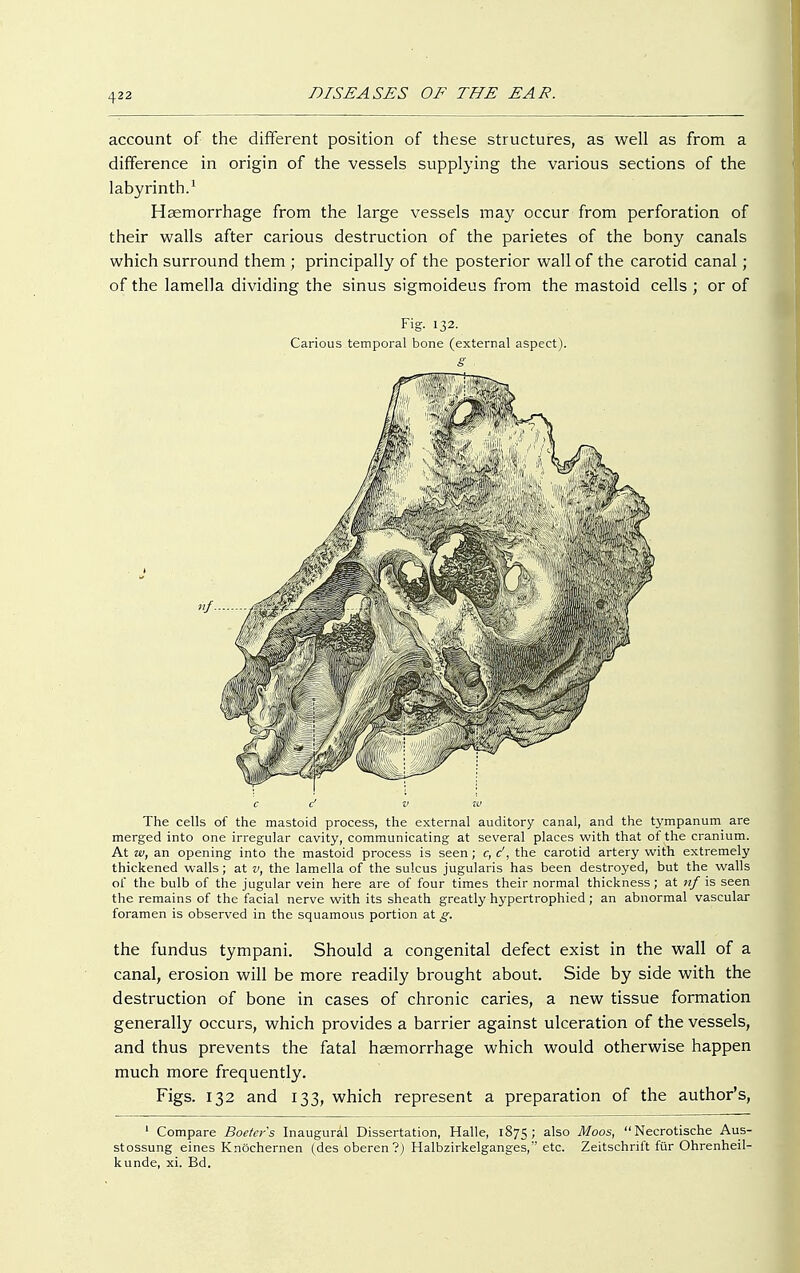 account of the different position of these structures, as well as from a difference in origin of the vessels supplying the various sections of the labyrinth.1 Haemorrhage from the large vessels may occur from perforation of their walls after carious destruction of the parietes of the bony canals which surround them ; principally of the posterior wall of the carotid canal; of the lamella dividing the sinus sigmoideus from the mastoid cells ; or of Fig. 132. Carious temporal bone (external aspect). The cells of the mastoid process, the external auditory canal, and the tympanum are merged into one irregular cavity, communicating at several places with that of the cranium. At w, an opening into the mastoid process is seen; c, d', the carotid artery with extremely thickened walls; at v, the lamella of the sulcus jugularis has been destroyed, but the walls of the bulb of the jugular vein here are of four times their normal thickness; at nf is seen the remains of the facial nerve with its sheath greatly hypertrophied; an abnormal vascular foramen is observed in the squamous portion at g. the fundus tympani. Should a congenital defect exist in the wall of a canal, erosion will be more readily brought about. Side by side with the destruction of bone in cases of chronic caries, a new tissue formation generally occurs, which provides a barrier against ulceration of the vessels, and thus prevents the fatal haemorrhage which would otherwise happen much more frequently. Figs. 132 and 133, which represent a preparation of the author's, 1 Compare Boetcrs Inaugural Dissertation, Halle, 1875; also Moos, Necrotische Aus- stossung eines Knöchernen (des oberen?) Halbzirkelganges, etc. Zeitschrift für Ohrenheil- kunde, xi. Bd.