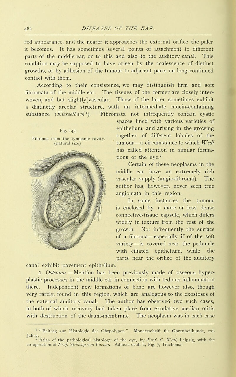 Fig- 143- Fibroma from the 'tympanic cavity, (natural size) red appearance, and the nearer it approaches the external orifice the paler it becomes. It has sometimes several points of attachment to different parts of the middle ear, or to this and also to the auditory canal. This condition may be supposed to have arisen by the coalescence of distinct growths, or by adhesion of the tumour to adjacent parts on long-continued contact with them. According to their consistence, we may distinguish firm and soft fibromata of the middle ear. The tissues of the former are closely inter- woven, and but slightly^vascular. Those of the latter sometimes exhibit a distinctly areolar structure, with an intermediate mucin-containing substance {Kiesselbach]). Fibromata not infrequently contain cystic spaces lined with various varieties of epithelium, and arising in the growing together of different lobules of the tumour—a circumstance to which Wedl has called attention in similar forma- tions of the eye.2 Certain of these neoplasms in the middle ear have an extremely rich vascular supply (angio-fibroma). The author has, however, never seen true angiomata in this region. In some instances the tumour is enclosed by a more or less dense ■ / //■ o >nnective-tissue capsule, which differs - wide])' m texture from the rest of the x Si /' growth. Not infrequently the surface I of a fibroma—especially if of the soft // variety—is covered near the peduncle with ciliated epithelium, while the parts near the orifice of the auditory canal exhibit pavement epithelium. 2. Osteoma.—Mention has been previously made of osseous hyper- plastic processes in the middle ear in connection with tedious inflammation there. Independent new formations of bone are however also, though very rarely, found in this region, which are analogous to the exostoses of the external auditory canal. The author has observed two such cases, in both of which recovery had taken place from exudative median otitis with destruction of the drum-membrane. The neoplasm was in each case 1 Beitrag zur Histologie der Ohrpolypen. Monatsschrift für Ohrenheilkunde, xxi. Jahrg. - Atlas of the pathological histology of the eye, by Prof. C. Wedl, Leipzig, with the co-operation of Prof. Stellwag von Carton. Adnexa oculi I., Fig. 7, Trachoma.