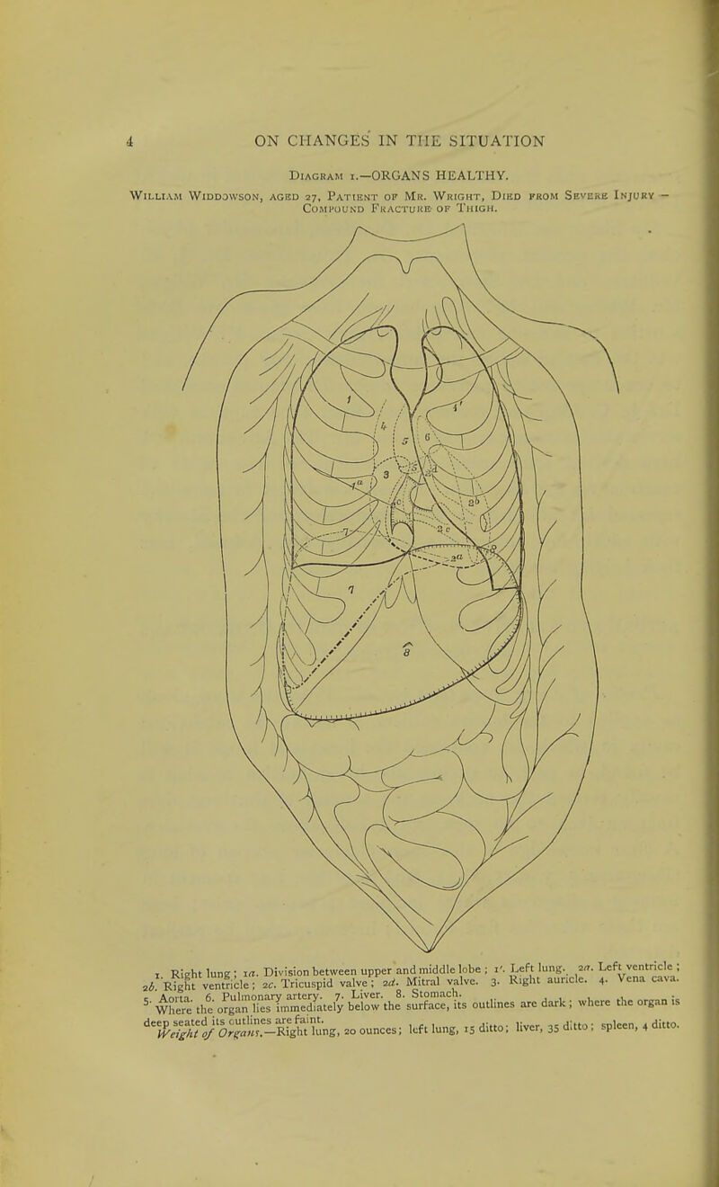 Diagram i.—ORGANS HEALTHY. WiLU.VM WiDDOWSON, AGED 27, PaTIENT OF Mr. WrIGHT, DiED FROM SEVERE INJURY - Compound Fracture- of Thigh. I RIeht lune ; i«. Division between upper and middle lobe ; i'. Left lung. ^n. Lef=t ventricle ; ^/■Right ventricle; Tricuspid valve; Mitral valve. 3- R>ght auncle. 4- Vena cava. ^tr. the oSn mStefy i^o%\yl-^^^A outlines are dark; where the organ is X^fl-E. .5 ditto; liver, 35 ditto; spleen, 4 ditto.