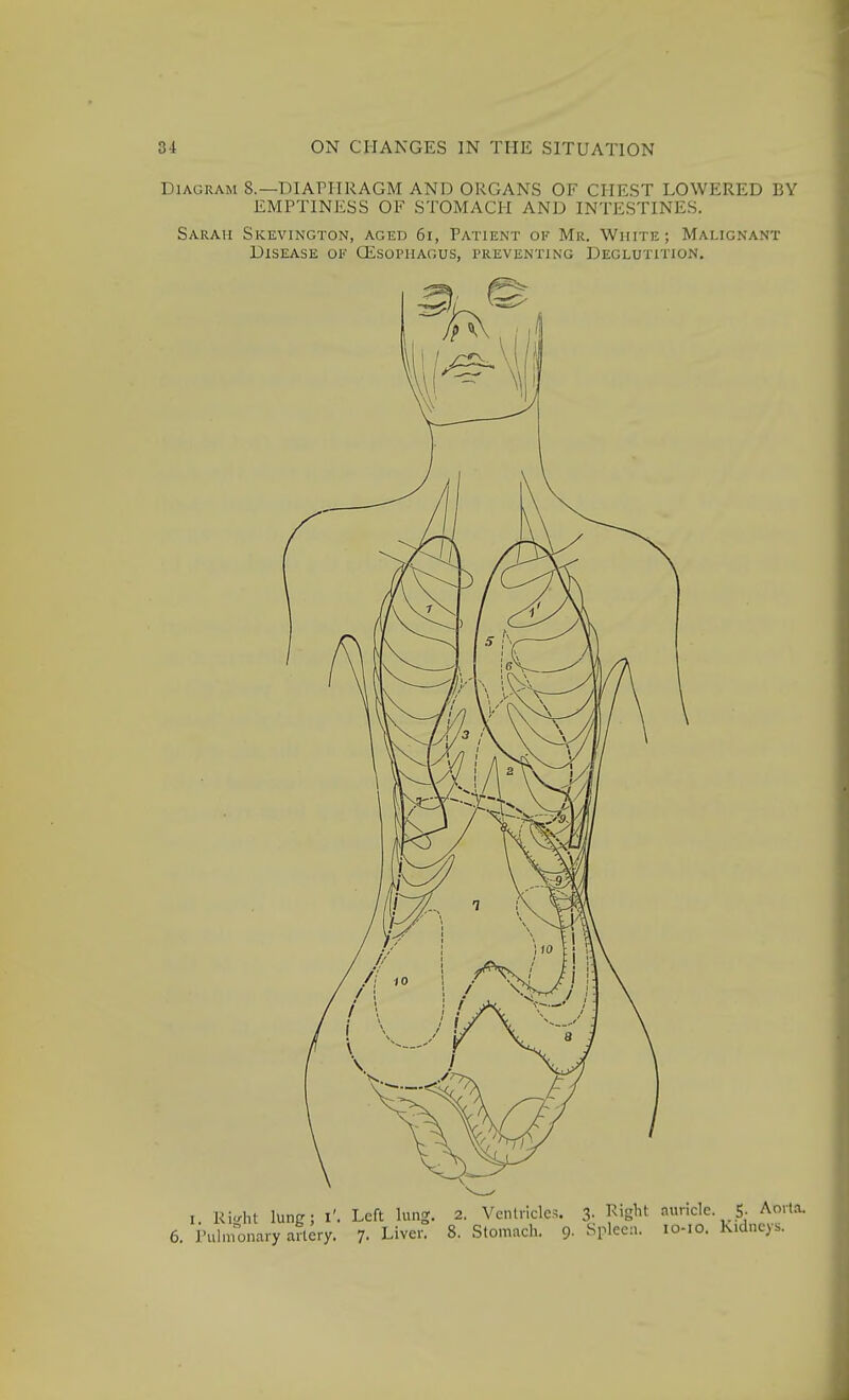Diagram 8.—DIAPHRAGM AND ORGANS OF CHEST LOWERED BY EMPTINESS OF STOMACH AND INTESTINES. Sarah Skevington, aged 6i, Patient ok Mr. White; Malignant Disease of CEsopiiagus, preventing Deglutition. I Ri</ht lunfr; I'. Left lung. 2. Ventricles. 3- ^''S^^ auricle. 5- Aort.-u 6. Pulmonary artery. 7- Liver. 8. Stomach. 9. Splee:!. lo-io. Kidneys.