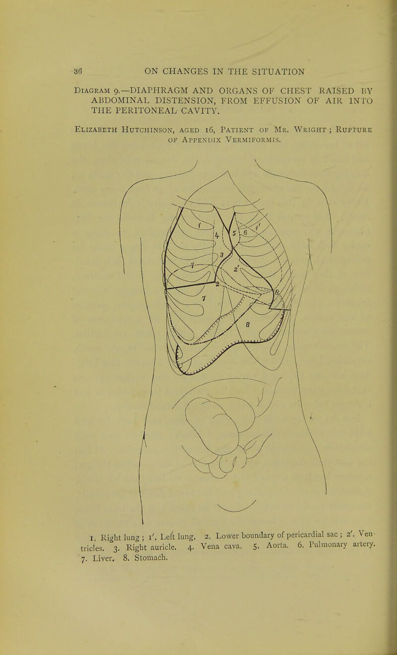 Diagram 9.—DIAPHRAGM AND ORGANS OF CHEST RAISED ABDOMINAL DISTENSION, FROM EFFUSION OF AIR INTO THE PERITONEAL CAVITY. Elizabeth Hutchinson, aged 16, Patient of Mr. Wright ; Rupture OF Appendix Vermiformis. I I. Richt lung ; i'. Left lung. 2. Lower boundary of pericardial sac ; 2'. Ven- tricles. °3. Right auricle. 4- Vena cava. 5- Aorta. 6. Pulmonary artery. 7. Liver. 8. Stomach.