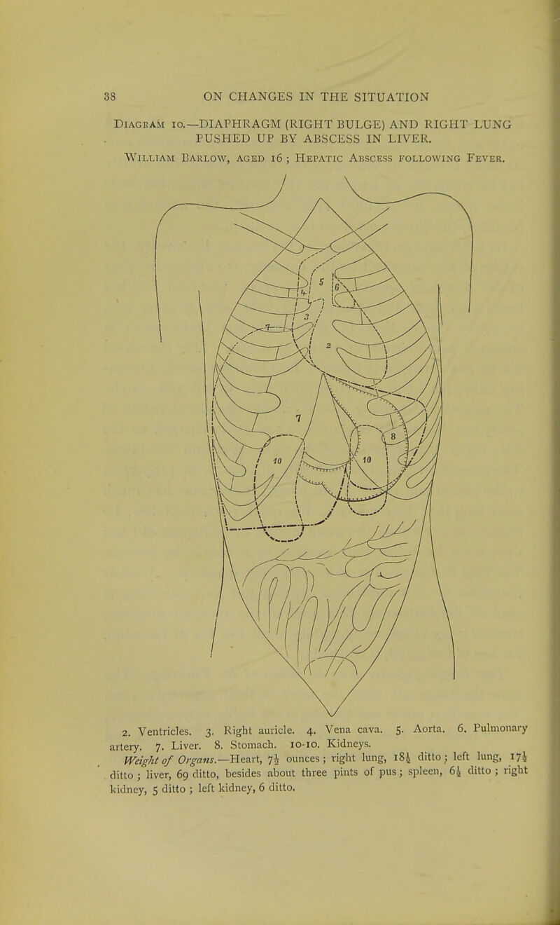 DiAGEAM 10.—DIAPHRAGM (RIGHT BULGE) AND RIGHT LUNG PUSHED UP BY ABSCESS IN LIVER. William Barlow, aged i6 ; Hepatic Abscess following Fever. 2. Ventricles. 3. Right auricle. 4. Vena cava. 5. Aorta. 6. Pulmonary artery. 7. Liver. 8. Stomach. 10-10. Kidneys. Weight of Organs—Ylca-rt, 7^ ounces; right lung, 184 ditto j left lung, I7i ditto ; liver, 69 ditto, besides about three pints of pus; spleen, 6i ditto ; right kidney, 5 ditto ; left kidney, 6 ditto.
