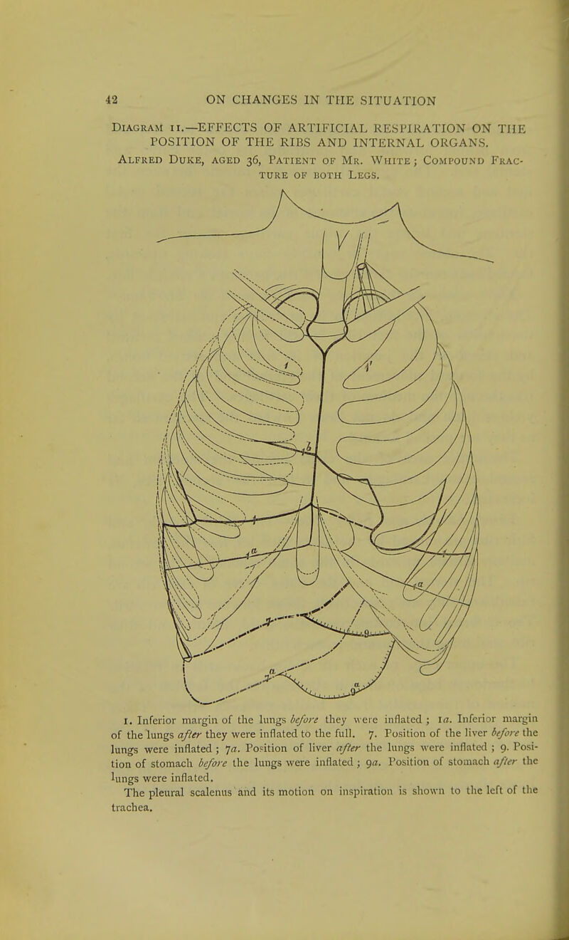 Diagram ii.—EFFECTS OF ARTIFICIAL RESPIRATION ON TIIE POSITION OF THE RIBS AND INTERNAL ORGANS. Alfred Duke, aged 36, Patient of Mr. White ; Compound Frac- ture OF BOTH Legs. I. Inferior margin of the lungs before they were inflated ; \a. Inferior margin of the lungs after they were inflated to the full. 7. Position of the liver before the lungs were inflated ; 7a. Popition of liver after the lungs were inflated ; 9. Posi- tion of stomach before the lungs were inflated ; 9^. Position of stomach after the Uings were inflated. The pleural scalenus and its motion on inspiration is shown to the left of the trachea.