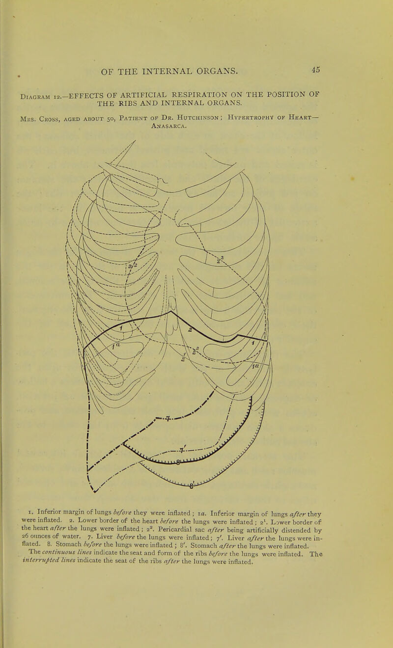 Diagram 12.-EFFECTS OF ARTIFICIAL RESPIRATION ON THE POSITION OF THE RIBS AND INTERNAL ORGANS. Mrs. Cross, aged about 50, Patient of Dr. Hutchinson; Hypertrophy of Heart— Anasarca. I. Inferior margin of lungs ^c/irff they were inflated; za. Inferior margin of lungs they were inflated. 2. Lower border of the heart fie/ore the hings were inflated ; 2^ Lower border of the heart after the lungs were inflated; 2^. Pericardial sac n//er being artificially distended by 26 ounces of water. 7. Liver /v/ore the lungs were inflated; 7'. Liver rt//6'rthe lungs were in- flated. 8. Stomach fcyW the lungs were inflated ; 8'. Stomach af/er the lungs were inflated. The continuous lines indicate the seat and form of the ribs be/ore llie lungs were inflated. The interrupted lines indicate the seat of the riljs after the lungs were inflated.
