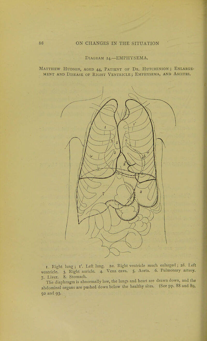Diagram 14.—EMPHYSEMA. Matthew Hudson, aged 44, Patient of Dr. Hutchinson ; Enlarge- ment AND Disease of Right Ventricle ; Emphysema, and Ascites. I. Right lung ; i'. Left lung. la. Right ventricle much enlarged ; 2h. l eft ventricle. 3. Right auricle, 4. Vena cava. 5. Aorta. 6. Pulmonary artery. 7. Liver. 8. Stomach. The diaphragm is abnormally low, the lungs and heart are drawn down, and the abdominal organs are pushed down below the healthy sites. (See pp. 88 and 89, 92 and 93.