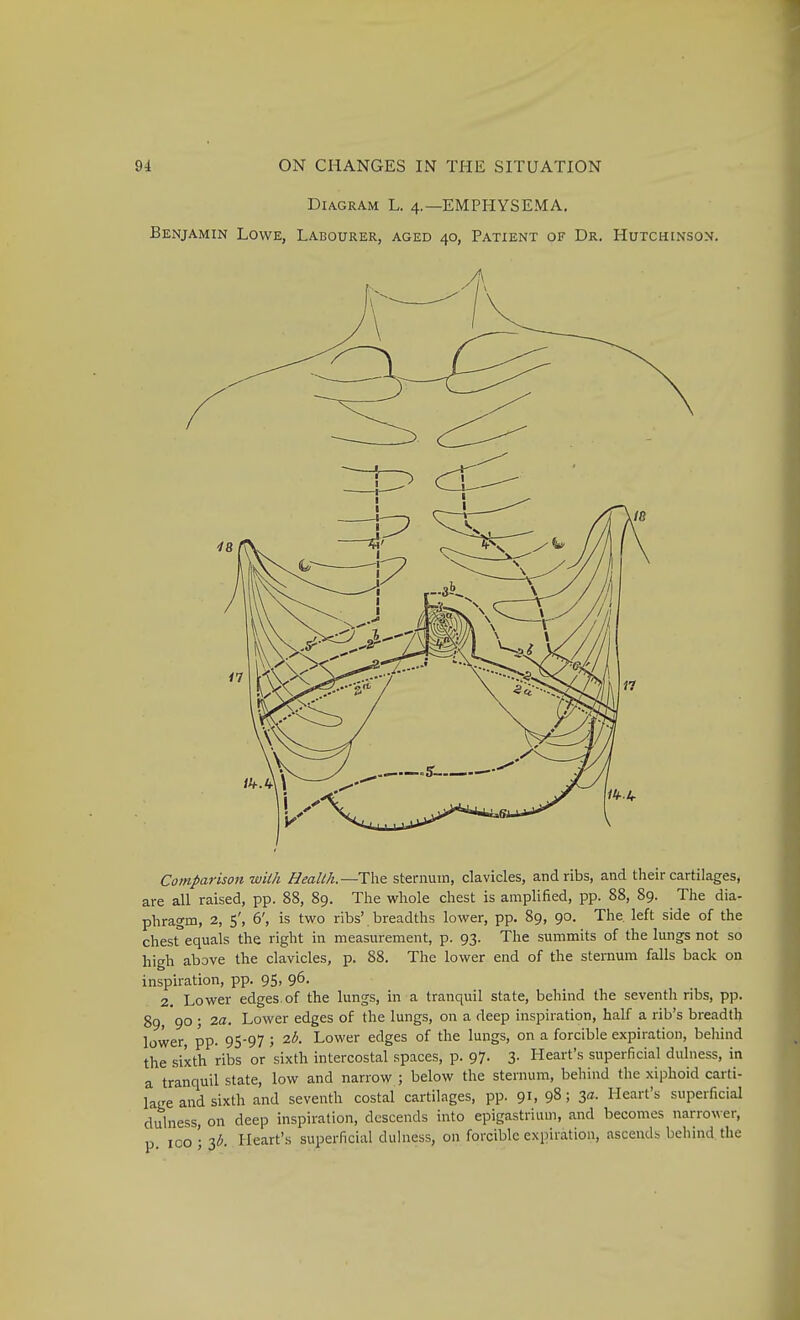 Diagram L. 4.—EMPHYSEMA. Benjamin Lowe, Labourer, aged 40, Patient of Dr. Hutchinson, Comparison wiih Health.—Tht sternum, clavicles, and ribs, and their cartilages, are all raised, pp. 88, 89. The whole chest is anipliSed, pp. 88, 89. The dia- phragm, 2, 5', 6', is two ribs' breadths lower, pp. 89, 90. The. left side of the chest equals the right in measurement, p. 93. The summits of the lungs not so high above the clavicles, p. 88. The lower end of the sternum falls back on inspiration, pp. 95, 96. 2. Lower edges, of the lungs, in a tranquil state, behind the seventh ribs, pp. 89, 90 ; 2a. Lower edges of the lungs, on a deep inspiration, half a rib's breadth lower, pp. 95-97 ; 25. Lower edges of the lungs, on a forcible expiration, beliind the sixth ribs or sixth intercostal spaces, p. 97. 3. Heart's superficial dulness, in a tranquil state, low and narrow ; below the sternum, behind the xiphoid carti- lage and sixth and seventh costal cartilages, pp. 91, 98; 3«- Heart's superficial dulness, on deep inspiration, descends into epigastrium, and becomes narrower, p 100 '• lb. Heart's superficial duhiess, on forcible expiration, ascends behind the