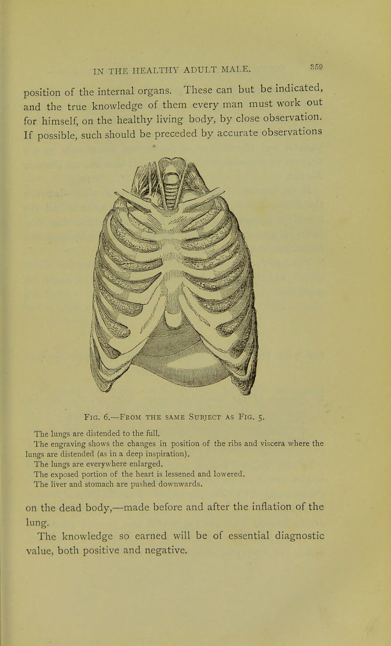 ?./59 position of the internal organs. These can but be indicated, and the true knowledge of them every man must work out for himself, on the healthy living body, by close observation. If possible, such should be preceded by accurate observations Fig. 6.—Feom the same Subject as Fig. 5. The lungs are distended to the full. The engraving shows the changes in position of the ribs and viscera where the lungs are distended (as in a deep inspiration). The lungs are everywhere enlarged. The exposed portion of the heart is lessened and lowered. The liver and stomach are pushed downwards. on the dead body,—made before and after the inflation of the lung. The knowledge so earned will be of essential diagnostic value, both positive and negative.