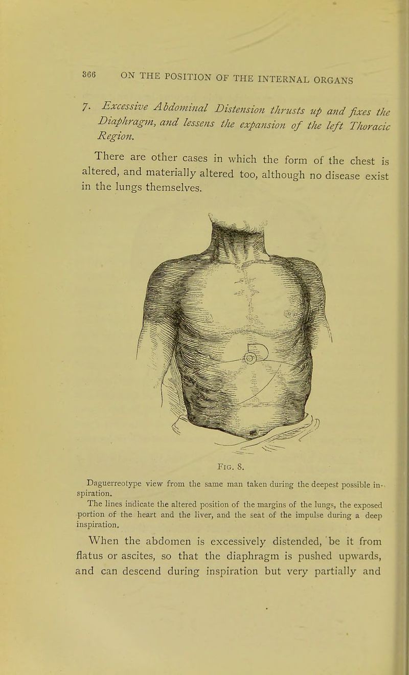 7. Excessive Abdominal Distension thrusts up and fixes the Diaphragm, and lessens the expansion of the left Thoracic Region. There are other cases in which the form of the chest is altered, and materially altered too, although no disease exist in the lungs themselves. Fig. 8. Daguerreolype view from the same man taken during the deepest possible in- spiration. The lines indicate the altered position of the margins of the lungs, the exposed portion of the heart and the liver, and the seat of the impulse during a deep inspiration. When the abdomen is excessively distended, be it from flatus or ascites, so that the diaphragm is pushed upwards, and can descend during inspiration but very partially and