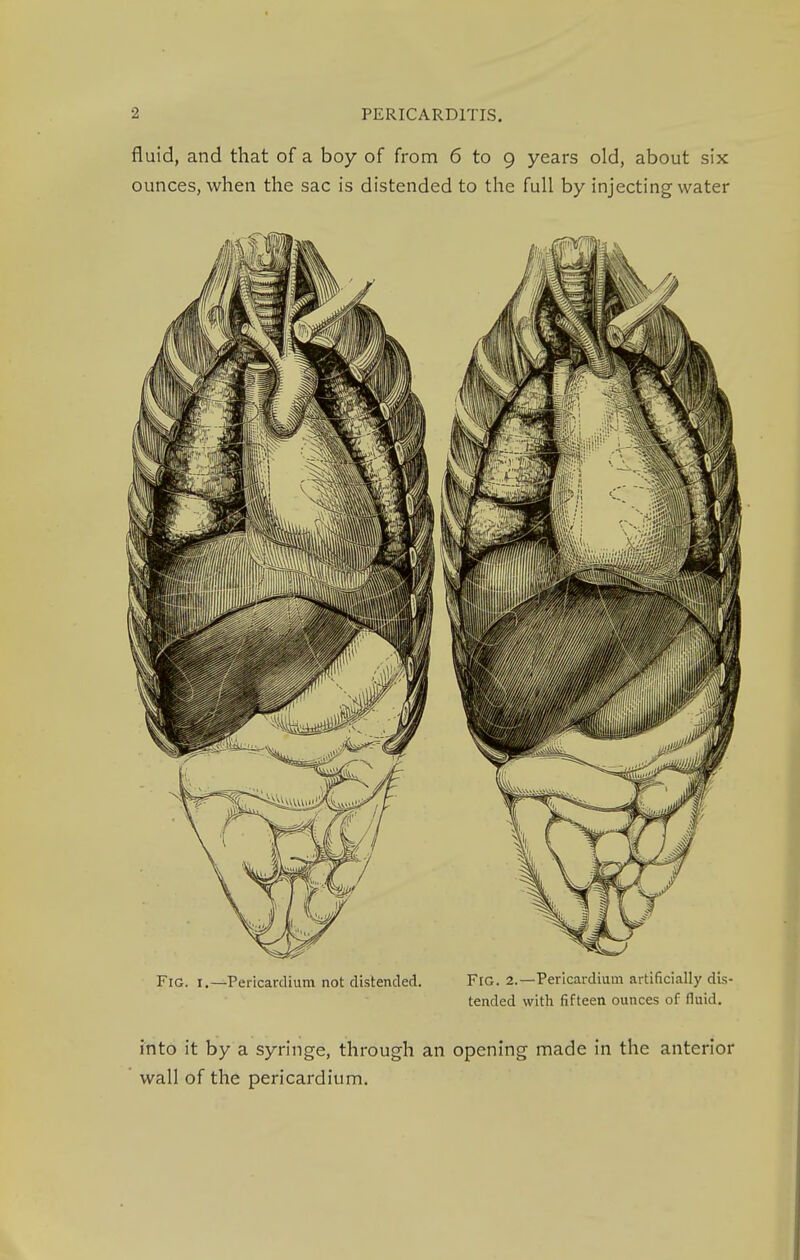 fluid, and that of a boy of from 6 to 9 years old, about six ounces, when the sac is distended to the full by injecting water Fig. 1.—Pericardium not distended. Fig. 2.—Pericardium artificially dis- tended with fifteen ounces of fluid. into it by a syringe, through an opening made in the anterior wall of the pericardium.