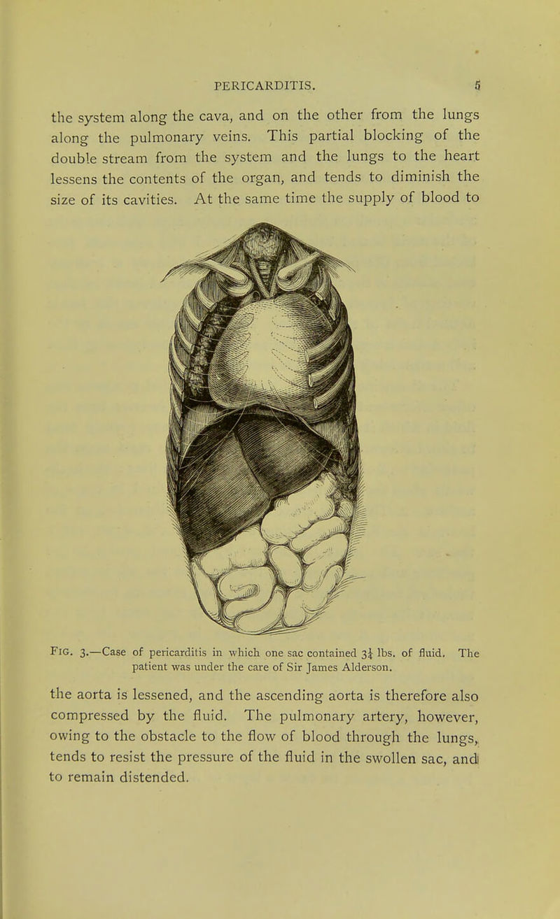 the system along the cava, and on the other from the lungs along the pulmonary veins. This partial blocking of the double stream from the system and the lungs to the heart lessens the contents of the organ, and tends to diminish the size of its cavities. At the same time the supply of blood to Fig. 3.—Case of pericarditis in which one sac contained 3^ lbs. of fluid. The patient was under the care of Sir James Alderson. the aorta is lessened, and the ascending aorta is therefore also compressed by the fluid. The pulmonary artery, however, owing to the obstacle to the flow of blood through the lungs, tends to resist the pressure of the fluid in the swollen sac, andi to remain distended.