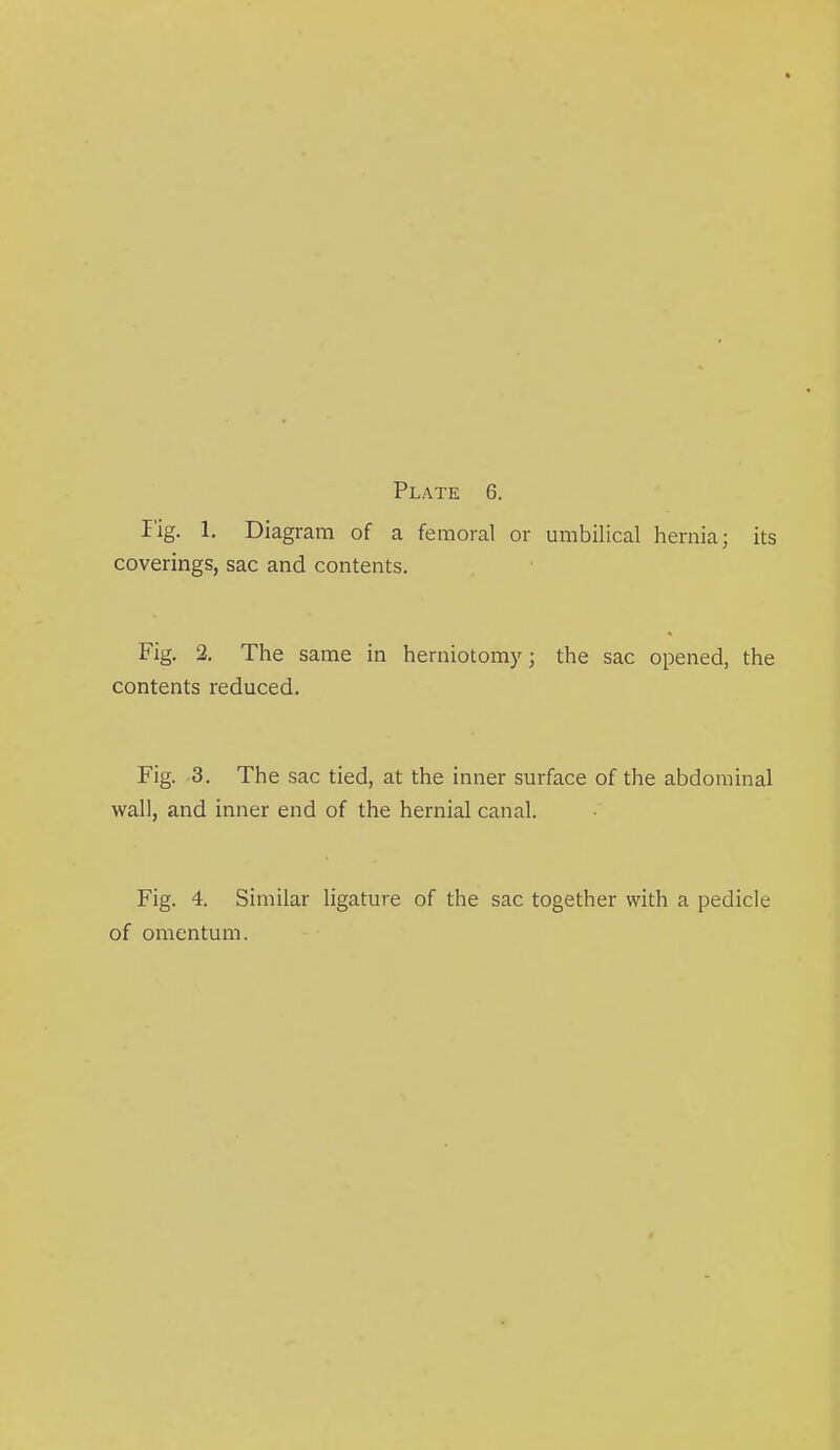 Fig. 1. Diagram of a femoral or umbilical hernia; its coverings, sac and contents. Fig. 2. The same in herniotomy; the sac opened, the contents reduced. Fig. 3. The sac tied, at the inner surface of the abdominal wall, and inner end of the hernial canal. Fig. 4. Similar ligature of the sac together with a pedicle of omentum.