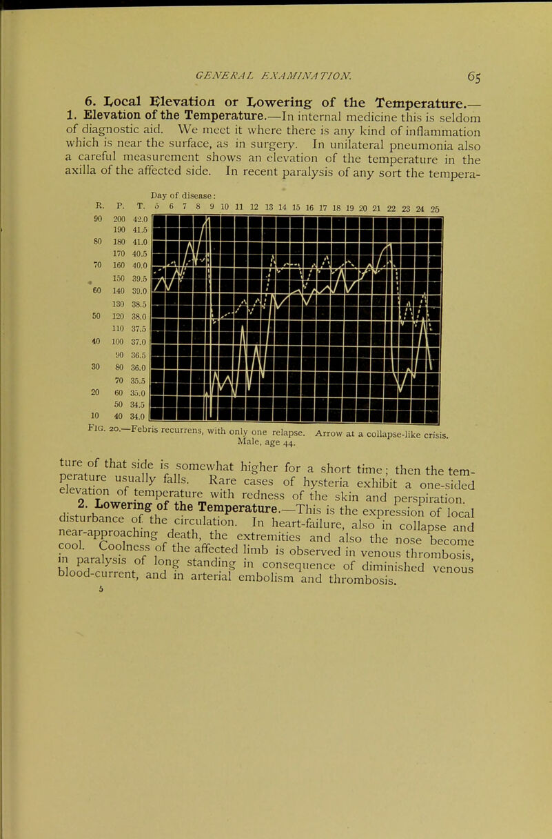 6. l/ocal Elevation or I^owering of the Temperature.— 1. Elevation of the Temperature.—In internal medicine this is seldom of diagnostic aid. We meet it where there is any kind of inflammation which is near the surface, as in surgery. In unilateral pneumonia also a careful measurement shows an elevation of the temperature in the axilla of the affected side. In recent paralysis of any sort the tempera- K. 90 80 60 50 40 30 20 10 Fig. p. 200 190 180 170 160 150 140 130 120 110 100 UO 80 70 60 50 40 20.— T. 42.0 41.5 41.0 40.5 40.0 39.5 39.0 38.5 38.0 37.5 37.0 36.5 36.0 35.5 35.0 34.5 34.0 Day of disease: Ö 6 7 8 9 10 11 12 13 14 15 16 17 18 19 20 21 22 23 24 25 llüVnissiiieniBBi u: WA nil nil iiBMBnaeMaMii ^■■■ir 'imii iniiiiiiiiiKin iHHiiiiiiie nRlilMnnnnBBnHw liar iir u i ■Febris recurrens, with only one relapse. Arrow at a collapse-like crisis Male, age 44. Deratnri n somewhat higher for a short time; then the tern- Son of ? ^ 'f- ^'t! ^y^^^^ ^^hibit a one-sided 2 LowpH^^Sf'fi''^ '^^^'^ °^ ^^^^ ^^'^ ^'^d perspiration. 2. Lowering of the Temperature.-This is the expression of local disturbance of the circulation. In heart-failure, also in collapse and near-approaching death, the extremities and also the nose become cool. Coolness of the affected limb is observed in venous thrombosTs m paralysis of long standing in consequence of diminished venous blood-current, and in arterial embolism and thrombosis 5