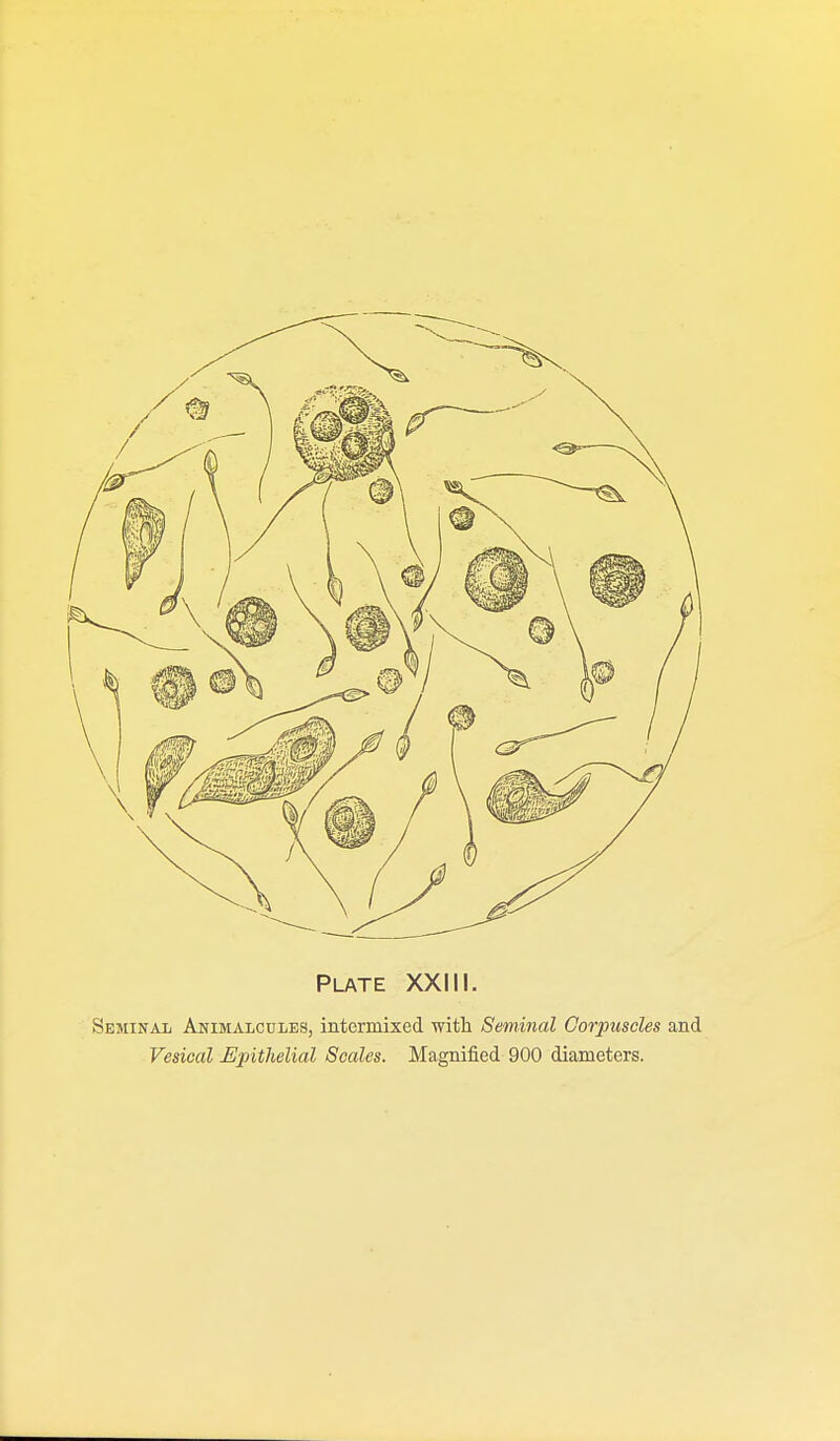 Seminal Animalc0les, intermixed with Seminal Corpuscles and Vesical Epithelial Scales. Magnified 900 diameters.