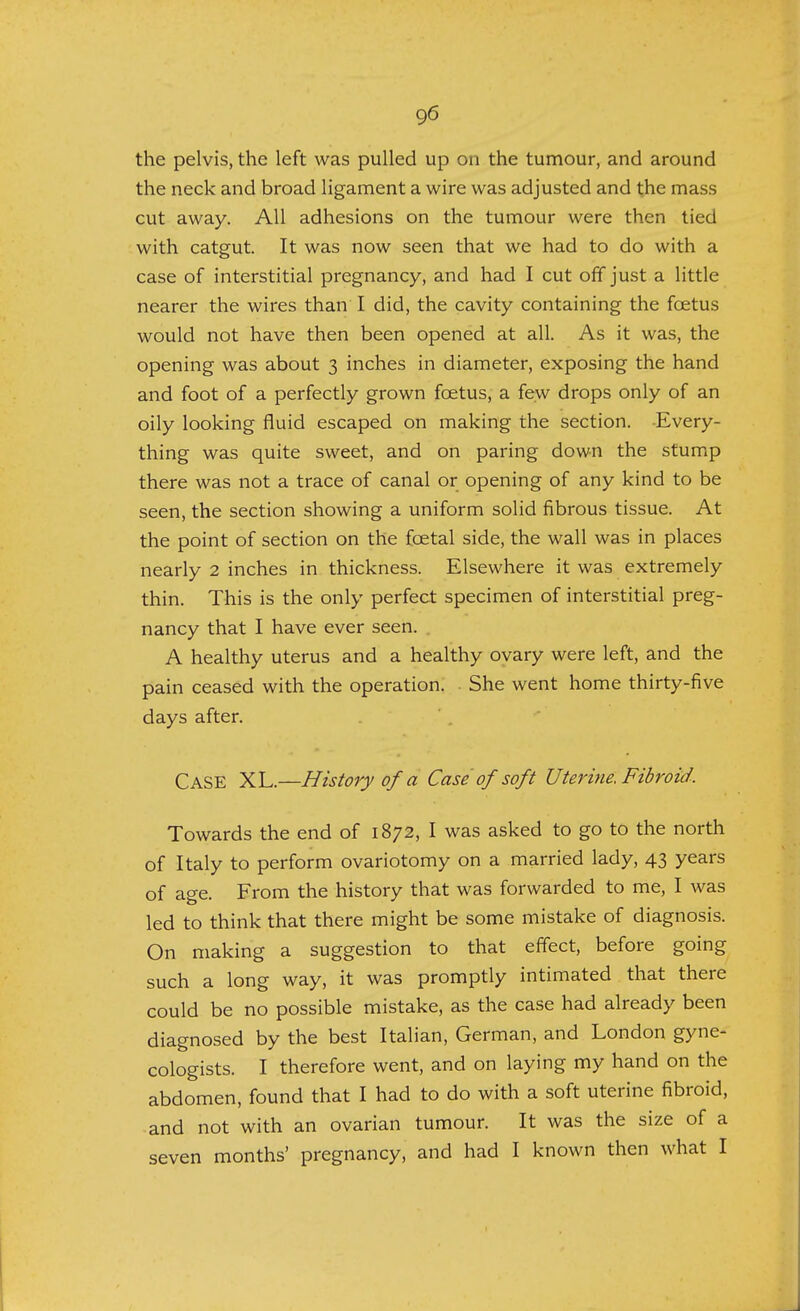 the pelvis, the left was pulled up on the tumour, and around the neck and broad ligament a wire was adjusted and the mass cut away. All adhesions on the tumour were then tied with catgut. It was now seen that we had to do with a case of interstitial pregnancy, and had I cut off just a little nearer the wires than I did, the cavity containing the foetus would not have then been opened at all. As it was, the opening was about 3 inches in diameter, exposing the hand and foot of a perfectly grown foetus, a few drops only of an oily looking fluid escaped on making the section. Every- thing was quite sweet, and on paring down the stump there was not a trace of canal or opening of any kind to be seen, the section showing a uniform solid fibrous tissue. At the point of section on the foetal side, the wall was in places nearly 2 inches in thickness. Elsewhere it was extremely thin. This is the only perfect specimen of interstitial preg- nancy that I have ever seen. A healthy uterus and a healthy ovary were left, and the pain ceased with the operation. She went home thirty-five days after. Case XL.—History of a Case of soft Uterine. Fibroid. Towards the end of 1872, I was asked to go to the north of Italy to perform ovariotomy on a married lady, 43 years of age. From the history that was forwarded to me, I was led to think that there might be some mistake of diagnosis. On making a suggestion to that effect, before going such a long way, it was promptly intimated that there could be no possible mistake, as the case had already been diagnosed by the best Italian, German, and London gyne- cologists. I therefore went, and on laying my hand on the abdomen, found that I had to do with a soft uterine fibroid, and not with an ovarian tumour. It was the size of a seven months' pregnancy, and had I known then what I