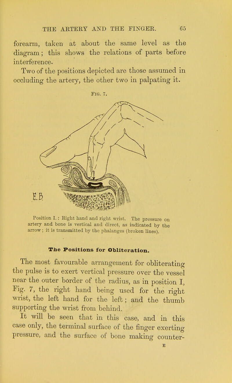 forearm, taken at about the same level as the diagram; this shows the relations of parts before interference. Two of the positions depicted are those assumed in occluding the artery, the other two in palpating it. Fig. 7. Position I.: Right hand and right wrist. The pressure on artery and bone is vertical and direct, as indicated by the arrow ; it is transmitted by the phalanges (broken lines). The Positions for Obliteration. The most favourable arrangement for obliterating the pulse is to exert vertical pressure over the vessel near the outer border of the radius, as in position I, Fig. 7, the right hand being used for the right wrist, the left hand for the left; and the thumb supporting the wrist from behind. It will be seen that in this case, and in this case only, the terminal surface of the finger exerting pressure, and the surface of bone making counter- E