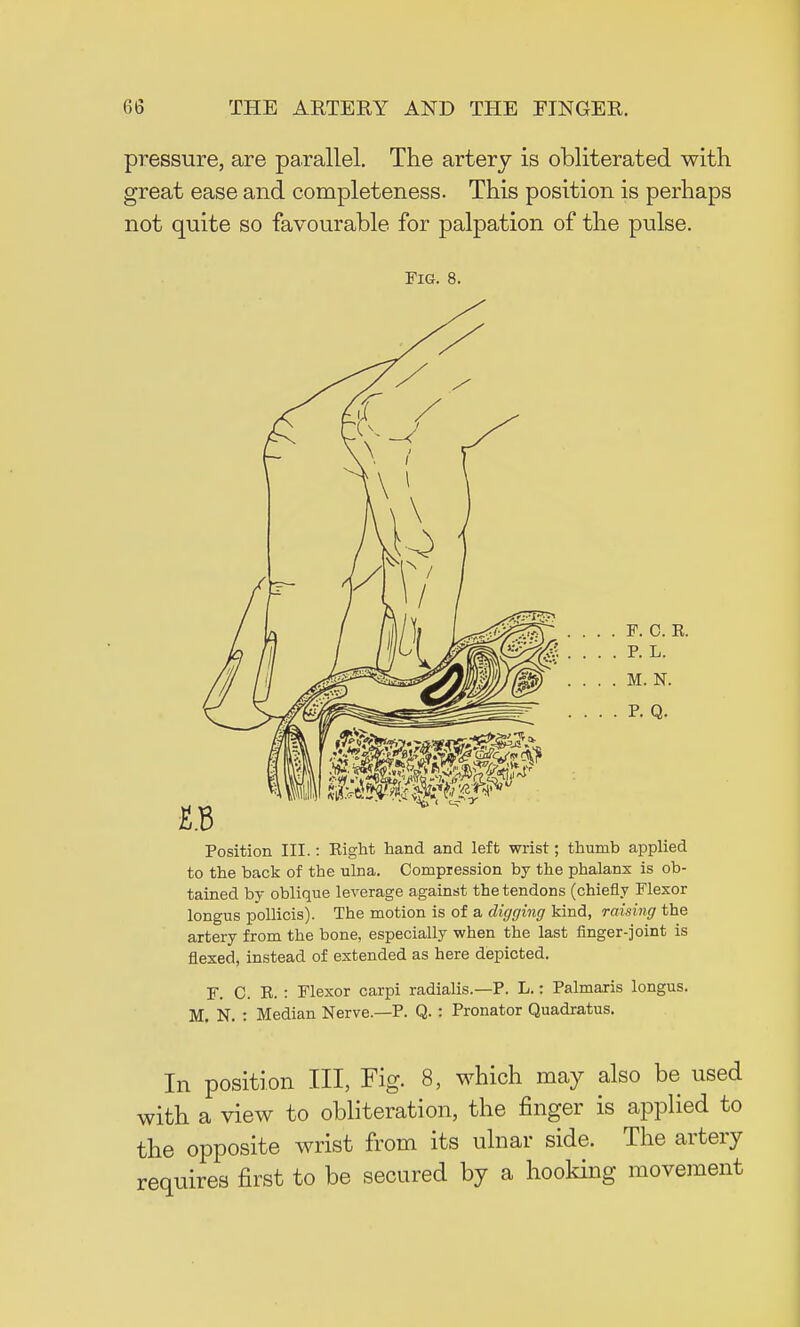 pressure, are parallel. The artery is obliterated with great ease and completeness. This position is perhaps not quite so favourable for palpation of the pulse. Fig. 8. Position III.: Right hand and left wrist; thumb applied to the back of the ulna. Compression by the phalanx is ob- tained by oblique leverage against the tendons (chiefly Flexor longus pollicis). The motion is of a digging kind, raising the artery from the bone, especially when the last finger-joint is flexed, instead of extended as here depicted. F. C. R. : Flexor carpi radialis.—P. L.: Palmaris longus. M. N. : Median Nerve.—P. Q.: Pronator Quadratus. In position III, Fig. 8, which may also be used with a view to obliteration, the finger is applied to the opposite wrist from its ulnar side. The artery requires first to be secured by a hooking movement