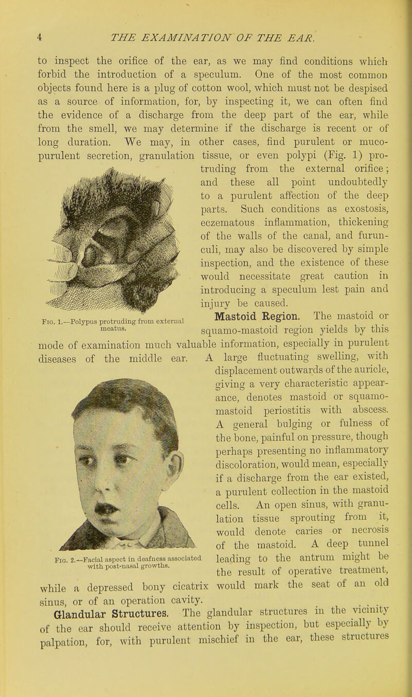 Fig. 1.—Polypus protmding from external meatus. to inspect the orifice of the ear, as we may find conditions which forbid the introduction of a speculum. One of the most common objects found here is a plug of cotton wool, which must not be despised as a source of information, for, by inspecting it, we can often find the evidence of a discharge from the deep part of the ear, while from the smell, we may determine if the discharge is recent or of long duration. We may, in other cases, find purulent or muco- purulent secretion, granulation tissue, or even polypi (Fig. 1) pro- truding from the external orifice; and these all point undoubtedly to a purulent affection of the deep parts. Such conditions as exostosis, eczematous inflammation, thickening of the walls of the canal, and furun- culi, may also be discovered by simple inspection, and the existence of these would necessitate great caution in introducing a speculum lest pain and injury be caused. Mastoid Region. The mastoid or squamo-mastoid region yields by this mode of examination much valuable information, especially in purulent diseases of the middle ear. A large fluctuating swelling, with displacement outwards of the auricle, giving a very characteristic appear- ance, denotes mastoid or squamo- mastoid periostitis with abscess. A general bulging or fulness of the bone, painful on pressure, though perhaps presenting no inflammatory discoloration, would mean, especially if a discharge from the ear existed, a purulent collection in the mastoid cells. An open sinus, with granu- lation tissue sprouting from it, would denote caries or necrosis of the mastoid. A deep tunnel leading to the antrum might be the result of operative treatment, while a depressed bony cicatrix would mark the seat of an old sinus, or of an operation cavity. _ Glandular Structures. The glandular structures in the vicinity of the ear should receive attention by inspection, but especially by palpation, for, with purulent mischief in the ear, these structures FiQ. 2.—Facial aspect in deafness associated with post-nasal growths.