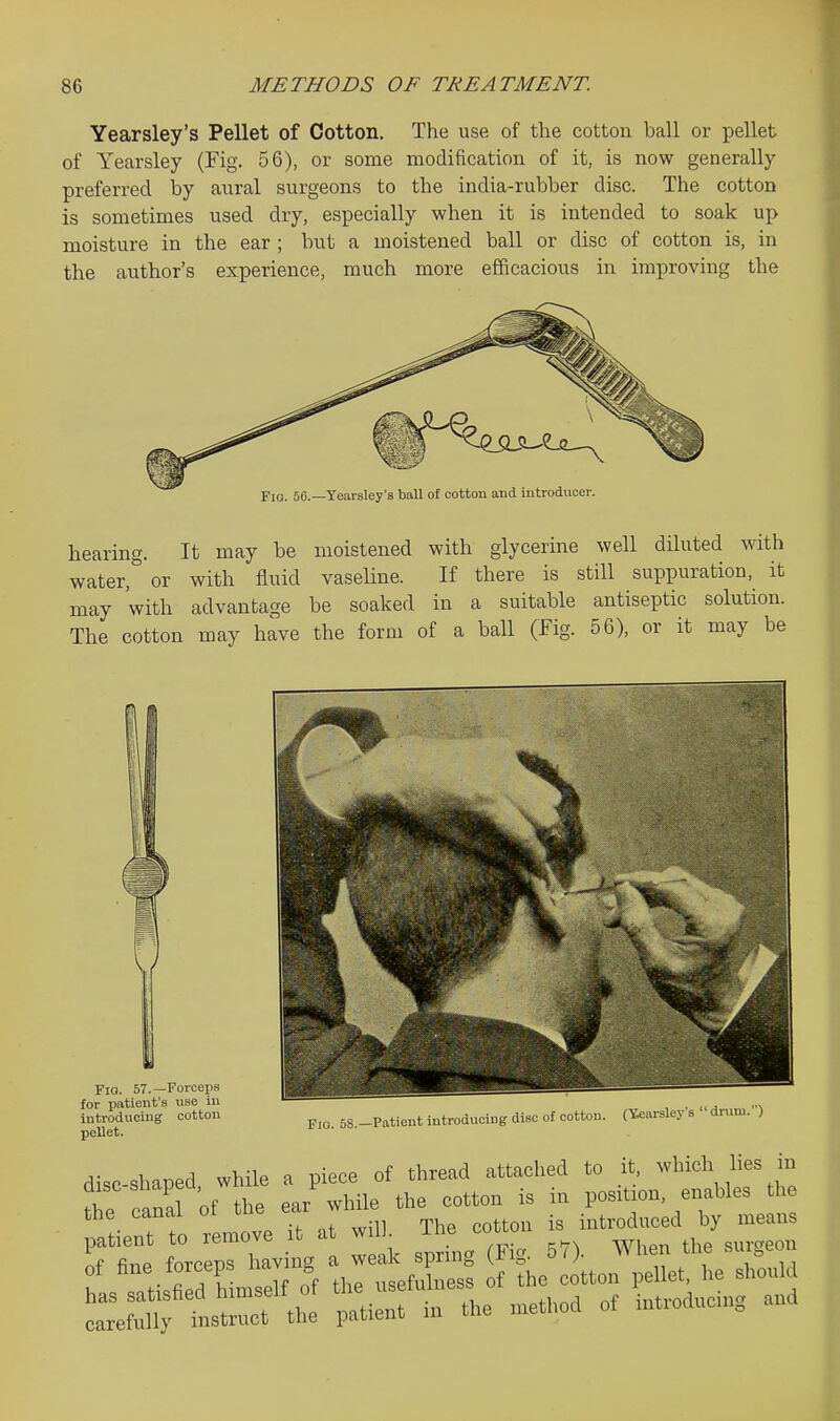Yearsley's Pellet of Cotton. The use of the cotton ball or pellet of Yearsley (Fig. 56), or some modification of it, is now generally preferred by aural surgeons to the india-rubber disc. The cotton is sometimes used dry, especially when it is intended to soak up moisture in the ear ; but a moistened ball or disc of cotton is, in the author's experience, much more efficacious in improving the Fig. 56.—Yearsley's ball of cotton and introdncer. hearing. It may be moistened with glycerine well diluted with water, or with fluid vaseUne. If there is still suppuration, it may with advantage be soaked in a suitable antiseptic solution. The cotton may have the form of a ball (fig. 56), or it may be Fio. 58.-Patient introducing disc of cotton. (T&arslcy s  drun.. •) Fio. 57.—Forceps for patient's use in introducing cotton pellet. disc-Shaped while a piece of thread attached to it, which lies in te cana of the ear while the cotton is in position, enables the the canal oi introduced by means patient to remove it a w IL ;° ,^^3 , of fine forceps having a - -^^^^^^^^ ^i J^^^^^ ^^^^^^^ ZSC^^ - method of introducing and
