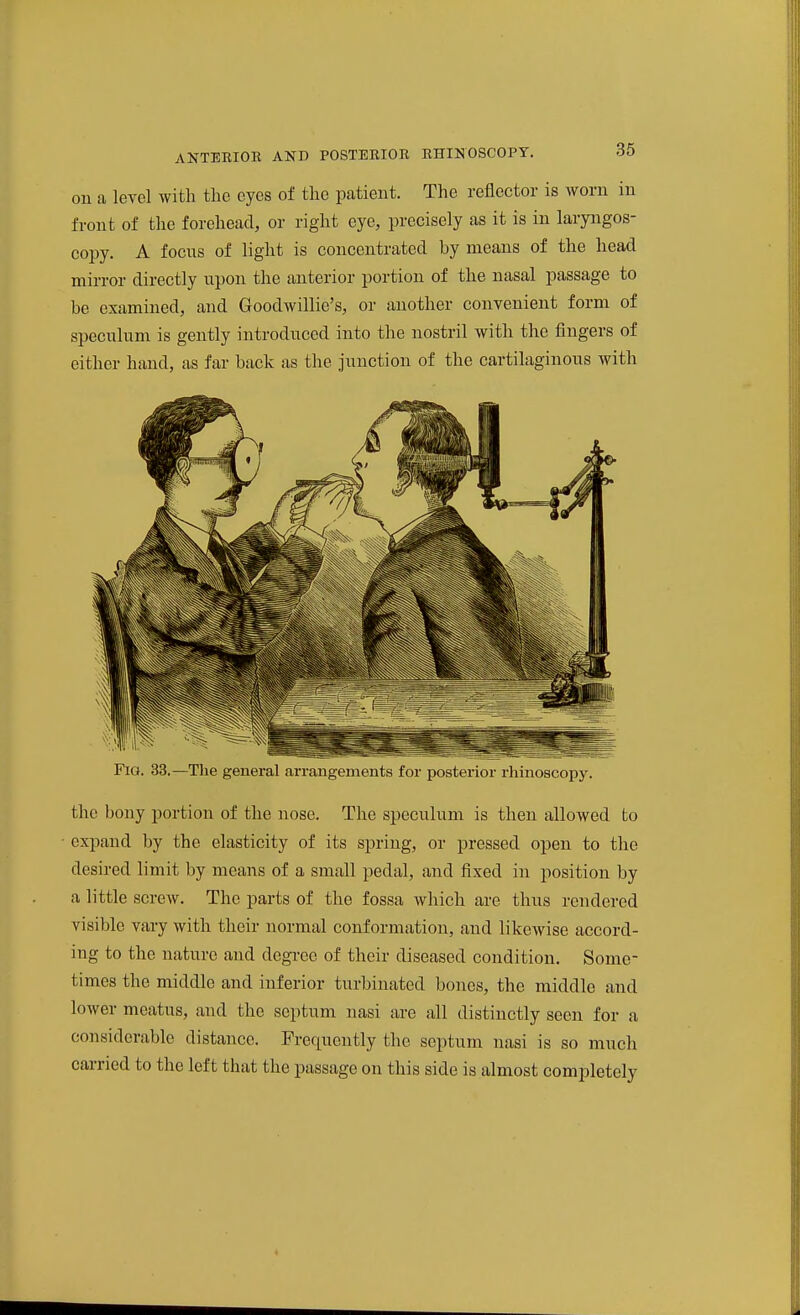 on a level with the eyes of the patient. The reflector is worn in front of the forehead, or right eye, precisely as it is in laryngos- copy. A focus of light is concentrated by means of the head mirror directly upon the anterior portion of the nasal passage to be examined, and Goodwillie's, or another convenient form of speculum is gently introduced into the nostril with the fingers of either hand, as far back as the junction of the cartilaginous with Fig. 33.—The general arrangements for posterior rhinoscopy. the bony portion of the nose. The speculum is then allowed to expand by the elasticity of its spring, or pressed open to the desired limit by means of a small pedal, and fixed in position by a little screw. The parts of the fossa which are thus rendered visible vary with their normal conformation, and likewise accord- ing to the nature and degree of their diseased condition. Some- times the middle and inferior turbinated bones, the middle and lower meatus, and the septum nasi are all distinctly seen for a considerable distance. Frequently the septum nasi is so much cai-ried to the left that the passage on this side is almost completely