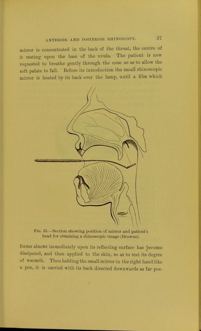 mirror is concentrated in tlie hack of the throat, the centre of it resting upon tlie base of the uvula. The patient is now requested to breathe gently through the nose so as to allow the soft palate to fall. Before its introduction the small rhinoscopic mirror is heated by its back over the lamp, until a film which Fig. 35.—Section showing position of mirror and patient's head for obtaining a rhinoscopic image (Browne). forms almcTst immediately upon its reflecting surface has become dissipated, and then applied to the skin, so as to test its degree of warmth. Then holding the small mirror in the right hand like a pen, it is carried with its back directed downwards as far pos-