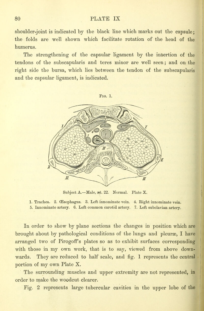 shoulder-joint is indicated by the black line which marks out the capsule; the folds are well shown which facihtate rotation of the head of the humerus. The strengthening of the capsular ligament bj the insertion of the tendons of the subscapularis and teres minor are well seen; and on the right side the bursa, which lies between the tendon of the subscapularis and the capsular ligament, is indicated. Fig. 1. Subject A.—Male, set. 22. Normal. Plate X. 1. Trachea. 2. CEsopliagus. 3. Left innominate vein. 4. Right innominate vein. 5. Innominate artery. 6. Left common carotid artery. 7. Left subclavian artery. In order to show by plane sections the changes in position which are brought about by pathological conditions of the lungs and pleurae, I have arranged two of Pirogoff's plates so as to exhibit surfaces corresponding with those in my own work, that is to say, viewed from above down- wards. They are reduced to half scale, and fig. 1 represents the central portion of my own Plate X. The surrounding muscles and upper extremity are not represented, in order to make the woodcut clearer. Fig. 2 represents large tubercular cavities in the upper lobe of the
