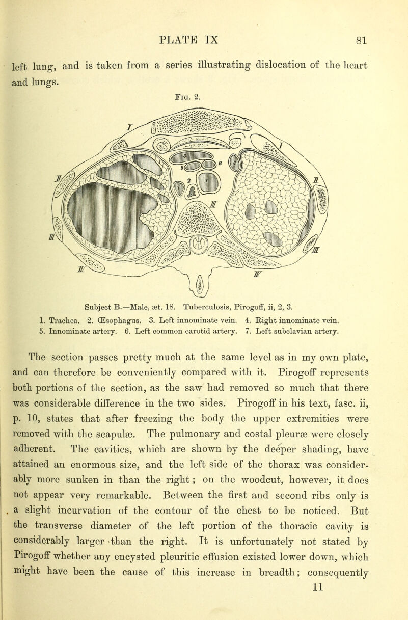 left lung, and is taken from a series illustrating dislocation of tlie heart and lungs. Fig. 2. Subject B.—Male, set. 18. Tuberculosis, Pirogoff, ii, 2, 3. 1. Trachea. 2. (Esophagus. 3. Left innominate vein. 4. Right innominate vein. 5. Innominate artery. 6. Left common carotid artery. 7. Left subclavian artery. The section passes pretty much at the same level as in my own plate, and can therefore be conveniently compared with it. Pirogoff represents both portions of the section, as the saw had removed so much that there was considerable difference in the two sides. Pirogoff in his text, fasc. ii, p. 10, states that after freezing the body the upper extremities were removed with the scapulse. The pulmonary and costal pleurse were closely adherent. The cavities, which are shown by the deeper shading, have attained an enormous size, and the left side of the thorax was consider- ably more sunken in than the right; on the woodcut, however, it does not appear very remarkable. Between the first and second ribs only is a slight incurvation of the contour of the chest to be noticed. But the transverse diameter of the left portion of the thoracic cavity is considerably larger than the right. It is unfortunately not stated by Pirogoff whether any encysted pleuritic effusion existed lower down, which might have been the cause of this increase in breadth; consequently 11