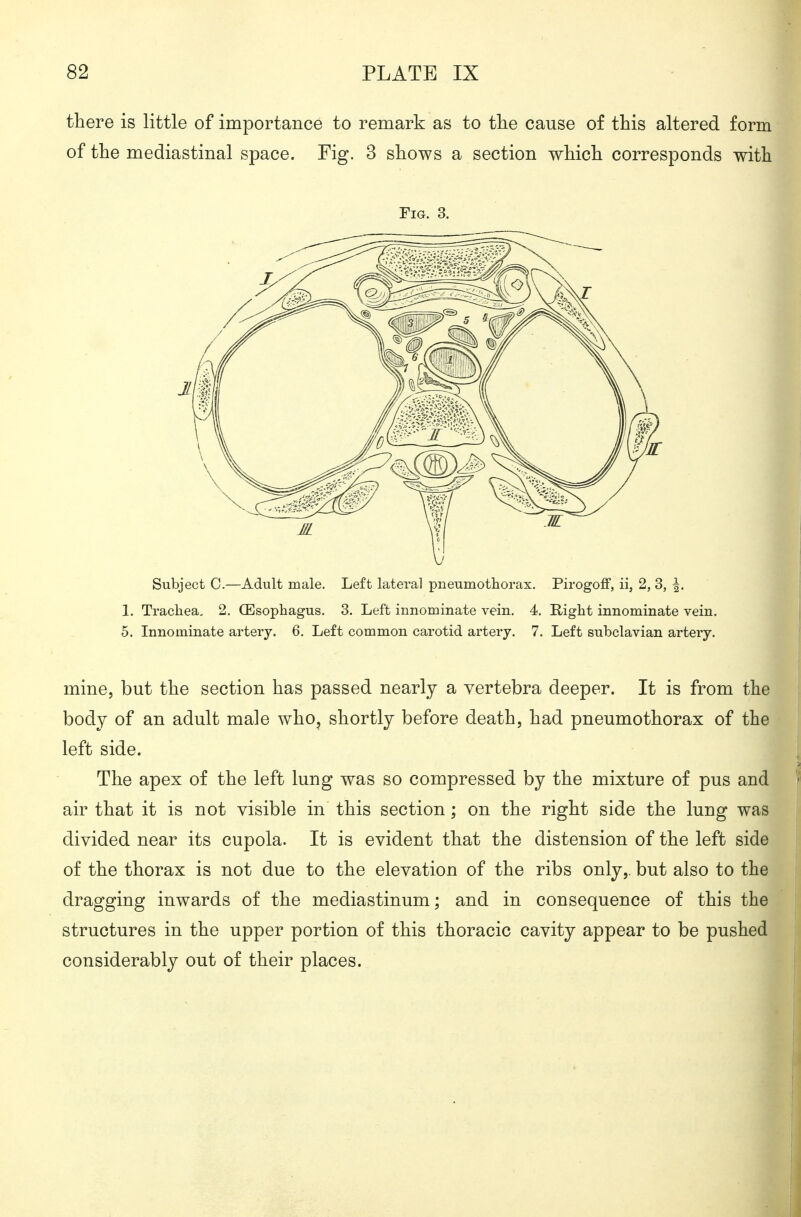 there is little of importance to remark as to tlie cause of this altered form of the mediastinal space. Fig. 3 shows a section which corresponds with Fig. 3. Subject C.—Adult male. Left lateral pneumothorax, Pirogoff, ii, 2, 3, |. 1. Trachea. 2. CEsophagus. 3. Left innominate vein. 4. Right innominate vein. 5. Innominate artery. 6. Left common carotid artery. 7. Left subclavian artery. mine, but the section has passed nearly a vertebra deeper. It is from the body of an adult male who, shortly before death, had pneumothorax of the left side. The apex of the left lung was so compressed by the mixture of pus and air that it is not visible in this section; on the right side the lung was divided near its cupola. It is evident that the distension of the left side of the thorax is not due to the elevation of the ribs only,, but also to the dragging inwards of the mediastinum; and in consequence of this the structures in the upper portion of this thoracic cavity appear to be pushed considerably out of their places.