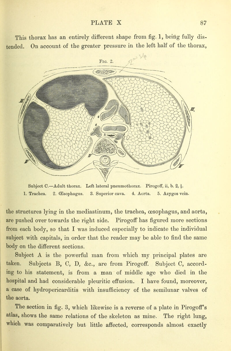 This thorax has an entirely different shape from fig. 1, being fully dis- tended. On account of the greater pressure in the left half of the thorax, Fig. 2. Subject C.—Adult thorax. Left lateral pneumothorax. Pirogoff, ii, b. 2, ^. 1. Trachea. 2. (Esophagus. 3. Superior cava. 4. Aorta. 5. Azygos vein. the structures lying in the mediastinum, the trachea, oesophagus, and aorta, are pushed over towards the right side. Pirogoff has figured more sections from each body, so that I was induced especially to indicate the individual subject with capitals, in order that the reader may be able to find the same body on the different sections. Subject A is the powerful man from which my principal plates are taken. Subjects B, 0, D, &c., are from Pirogoff. Subject C, accord- ing to his statement, is from a man of middle age who died in the hospital and had considerable pleuritic effusion. I have found, moreover, I a case of hydropericarditis with insufiiciency of the semilunar valves of j the aorta. j The s-ection in fig. 3, which likewise is a reverse of a plate in Pirogoff's I atlas, shows the same relations of the skeleton as mine. The right lung, I which was comparatively but little affected, corresponds almost exactly