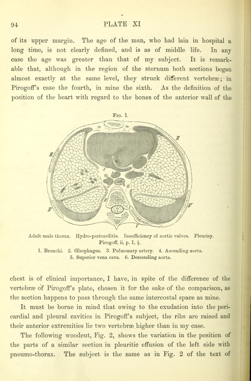 of its upper margin. Tlie age of ttie man, who had lain in hospital a long time, is not clearly defined, and is as of middle life. In any case the age was greater than that of my subject. It is remark- able that, although in the region of the sternum both sections began almost exactly at the same level, they struck different vertebrae; in Pirogoff's case the fourth, in mine the sixth. As the definition of the position of the heart with regard to the bones of the anterior wall of the Fig. 1. Adult male tliorax. Hydi'o-pericarditis. Insufficiency of aortic valves. Pleurisy. Pirogoff, ii, p. 1, 1. Bronchi. 2. (Esophagus. 3. Pulmonary artery. 4. Ascending aorta. 5. Superior vena cava. 6. Descending aorta. chest is of clinical importance, I have, in spite of the difference of the vertebrae of Pirogoff's plate, chosen it for the sake of the comparison, as the section happens to pass through the same intercostal space as mine. It must be borne in mind that owing to the exudation into the peri- cardial and pleural cavities in Pirogoff's subject, the ribs are raised and their anterior extremities lie two vertebrae higher than in my case. The following woodcut. Fig. 2, shows the variation in the position of the parts of a similar section in pleuritic effusion of the left side with pneumo-thorax. The subject is the same as in Fig. 2 of the text of