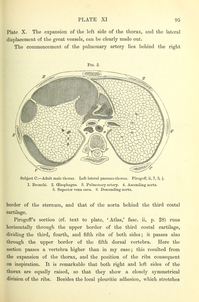 Plate X. The expansion of tlie left side of the thorax, and the lateral displacement of the great vessels, can be clearly made out. The commencement of the pulmonary artery lies behind the right border of the sternum, and that of the aorta behind the third costal cartilage. Pirogoff's section (cf. text to plate, 'Atlas,' fasc. ii, p. 28) runs horizontally through the upper border of the third costal cartilage, dividing the third, fourth, and fifth ribs of both sides; it passes also through the upper border of the fifth dorsal vertebra. Here the section passes a vertebra higher than in my case; this resulted from the expansion of the thorax, and the position of the ribs consequent on inspiration. It is remarkable that both right and left sides of the thorax are equally raised, so that they show a closely symmetrical division of the ribs. Besides the local pleuritic adhesion, which stretches