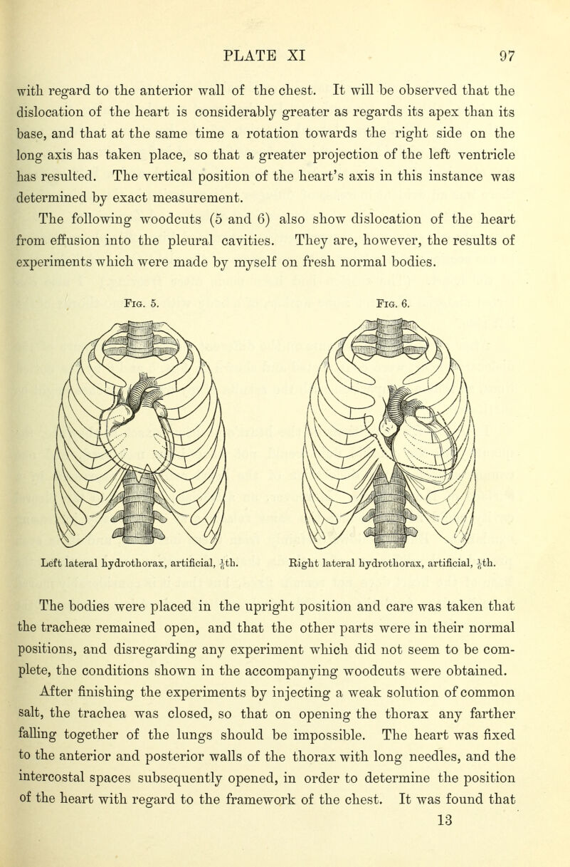 with regard to the anterior wall of the chest. It will be observed that the dislocation of the heart is considerably greater as regards its apex than its base, and that at the same time a rotation towards the right side on the long axis has taken place, so that a greater projection of the left ventricle has resulted. The vertical position of the heart's axis in this instance was determined by exact measurement. The following woodcuts (5 and 6) also show dislocation of the heart from effusion into the pleural cavities. They are, however, the results of experiments which were made by myself on fresh normal bodies. Fig. 5. Fig. 6. Left lateral hydrothorax, artificial, ^tb. Right lateral hydrotLorax, artificial, ^th. The bodies were placed in the upright position and care was taken that the tracheas remained open, and that the other parts were in their normal positions, and disregarding any experiment which did not seem to be com- plete, the conditions shown in the accompanying woodcuts were obtained. After finishing the experiments by injecting a weak solution of common salt, the trachea was closed, so that on opening the thorax any farther falling together of the lungs should be impossible. The heart was fixed to the anterior and posterior walls of the thorax with long needles, and the mtercostal spaces subsequently opened, in order to determine the position of the heart with regard to the framework of the chest. It was found that 13