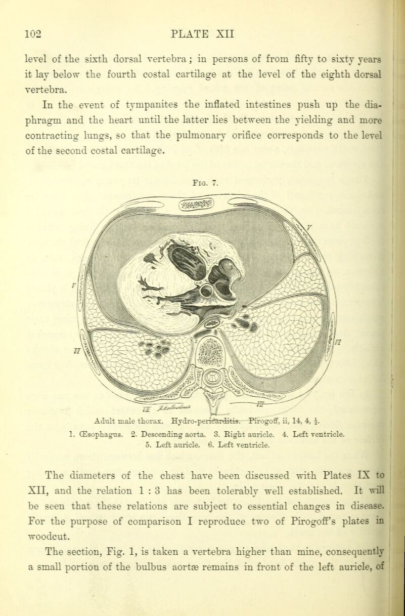 level of the sixth dorsal vertebra ; in persons of from fifty to sixty years it lay below the fourth costal cartilage at the level of the eighth dorsal vertebra. In the event of tympanites the inflated intestines push up the dia- phragm and the heart until the latter lies between the yielding and more contracting lungs, so that the pulmonary orifice corresponds to the level of the second costal cartilage. IlCr. Ad'.:!: iriilc '.hy.-ix. HTdrc-peHcnrditis. Pivrgor. ii. 14, 4. k 1. CEsopliagiis. Descending ao:-:.a. 3. High: -uriole. 4. Lei: ventricle. 5, Lci: aurio-e, 6. Left ventricle. The diameters of the chest have been discussed vrith Plates IX to XII. and the relation 1 : 3 has been tolerablv well established. It will be seen that these relations are subject to essential changes in disease. Por the purpose of comparison I reproduce two of Pmogofi's plates in woodcut. The section. Pig. 1. is taken a vertebra higher than mine, consequently a small portion of the bulbus aorta? remains in fi-ont of the left auricle, of