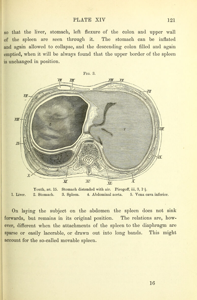 so that the liver, stoinach, left flexure of the colon and upper wall of the spleen are seen through it. The stomach can be inflated and again allowed to collapse, and the descending colon filled and again emptied, when it will be always found that the upper border of the spleen is unchanged in position. Fig. 3. Toutli, set. 15. Stomacla distended witli air. Pirogoff, iii, 3, 1. Liver. 2. Stomach. 3. Spleen. 4. Abdominal aorta. 5. Yena cava inferior. On laying the subject on the abdomen the spleen does not sink forwards, but remains in its original position. The relations are, how- ever, different when the attachments of the spleen to the diaphragm are sparse or easily lacerable, or drawn out into long bands. This might account for the so-called movable spleen. 16