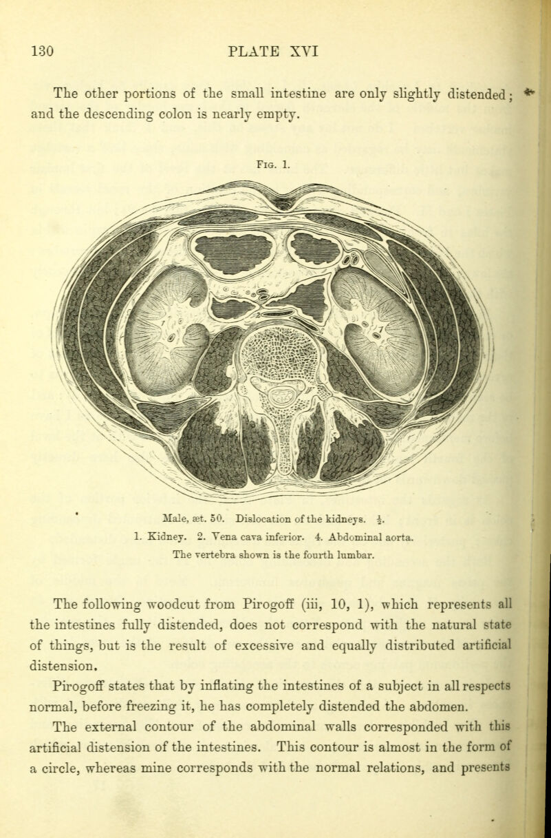 The other portions of the small intestine are only slightly distended; and the descending colon is nearly empty. Fig. 1. Male, set. 50. Dislocation of the kidneys, i. 1. Kidney. 2. Yena cava inferior. 4. Abdominal aorta. The vertebra shown is the fourth, lumbar. The following woodcut from Pirogoff (iii, 10, 1), which represents all the intestines fully distended, does not correspond with the natural state of things, but is the result of excessive and equally distributed artificial distension. Pirogoff states that by inflating the intestines of a subject in all respects normal, before freezing it, he has completely distended the abdomen. The external contour of the abdominal walls corresponded with this artificial distension of the intestines. This contour is almost in the form of a circle, whereas mine corresponds with the normal relations, and presents