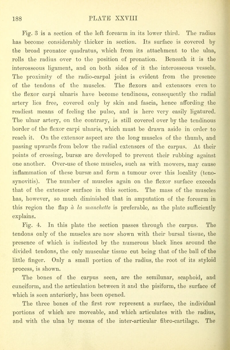 Fig. 3 is a section of the left forearm in its lower third. Tlie radius has become considerably thicker in section. Its surface is covered by the broad pronator quadratus, which from its attachment to the ulna, rolls the radius over to the position of pronation. Beneath it is the interosseous ligament, and on both sides of it the interosseous vessels. The proximity of the radio-carpal joint is evident from the presence of the tendons of the muscles. The flexors and extensors even to the flexor carpi ulnaris have become tendinous, consequently the radial artery lies free, covered only by skin and fascia, hence a0*ording the readiest means of feeling the pulse, and is here very easily ligatured. The ulnar artery, on the contrary, is still covered over by the tendinous border of the flexor carpi ulnaris, which must be drawn aside in order to reach it. On the extensor aspect are the long muscles of the thumb, and passing upwards from below the radial extensors of the carpus. At their points of crossing, bursse are developed to prevent their rubbing against one another. Over-use of these muscles, such as with mowers, may cause inflammation of these bursge and form a tumour over this locality (teno- synovitis). The number of muscles again on the flexor surface exceeds that of the extensor surface in this section. The mass of the muscles has, however, so much diminished that in amputation of the forearm in this region the flap a la mancheUe is preferable, as the plate sufficiently explains. Fig. 4. In this plate the section passes through the carpus. The tendons only of the muscles are now shown with their bursal tissue, the presence of which is indicated by the numerous black lines around the divided tendons, the only muscular tissue cut being that of the ball of the little finger. Only a small portion of the radius, the root of its styloid process, is shown. The bones of the carpus seen, are the semilunar, scaphoid, and cuneiform, and the articulation between it and the pisiform, the surface of which is seen anteriorly, has been opened. The three bones of the first row represent a surface, the individual portions of which are moveable, and which articulates with the radius, and with the ulna by means of the inter-articular fibro-cartilage. The