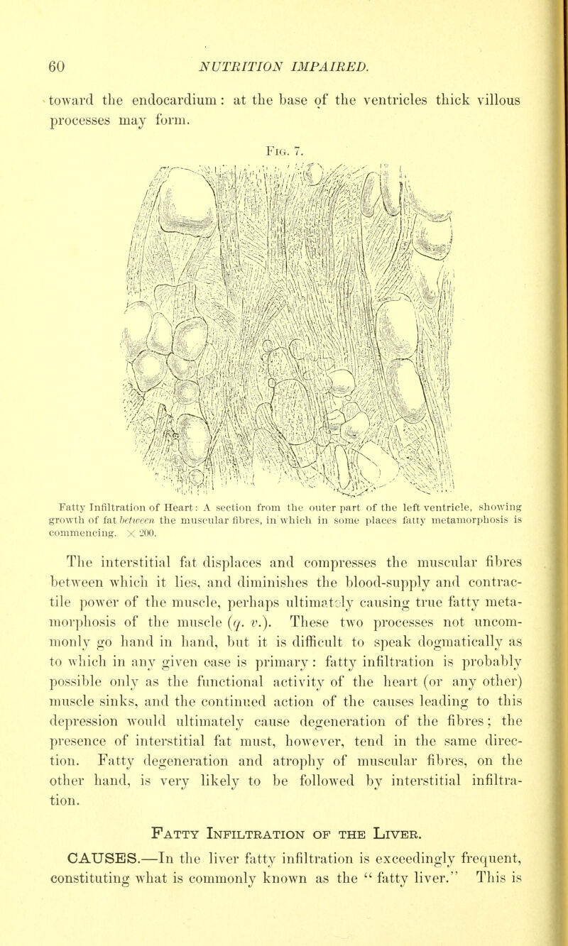 toward the endocardium: at the base of the ventricles thick villous processes may form. Fio. 7. Fatty Infiltration of Heart: A section from the outer part of the left ventricle, showing growth of fat between the mnscular fibres, in which in some places fatty metamorphosis is commencing. X 200. The interstitial fat displaces and compresses the muscular fibres between w^iich it lies, and diminishes the blood-supply and contrac- tile power of the muscle, perhaps ultimately causing true fatty meta- morphosis of the muscle {q. v.). These two processes not uncom- monly go hand in hand, but it is difficult to speak dogmatically as to which in any given case is primary : fatty infiltration is probably possible only as the functional activity of the heart (or any other) muscle sinks, and the continued action of the causes leading to this depression would ultimately cause degeneration of the fibres; the presence of interstitial fat must, however, tend in the same direc- tion. Fatty degeneration and atrophy of muscular fibres, on the other hand, is very likely to be followed by interstitial infiltra- tion. Fatty Infiltration of the Liver. CAUSES.—In the liver fatty infiltration is exceedingly frequent, constituting what is commonly known as the  fatty liver. This is