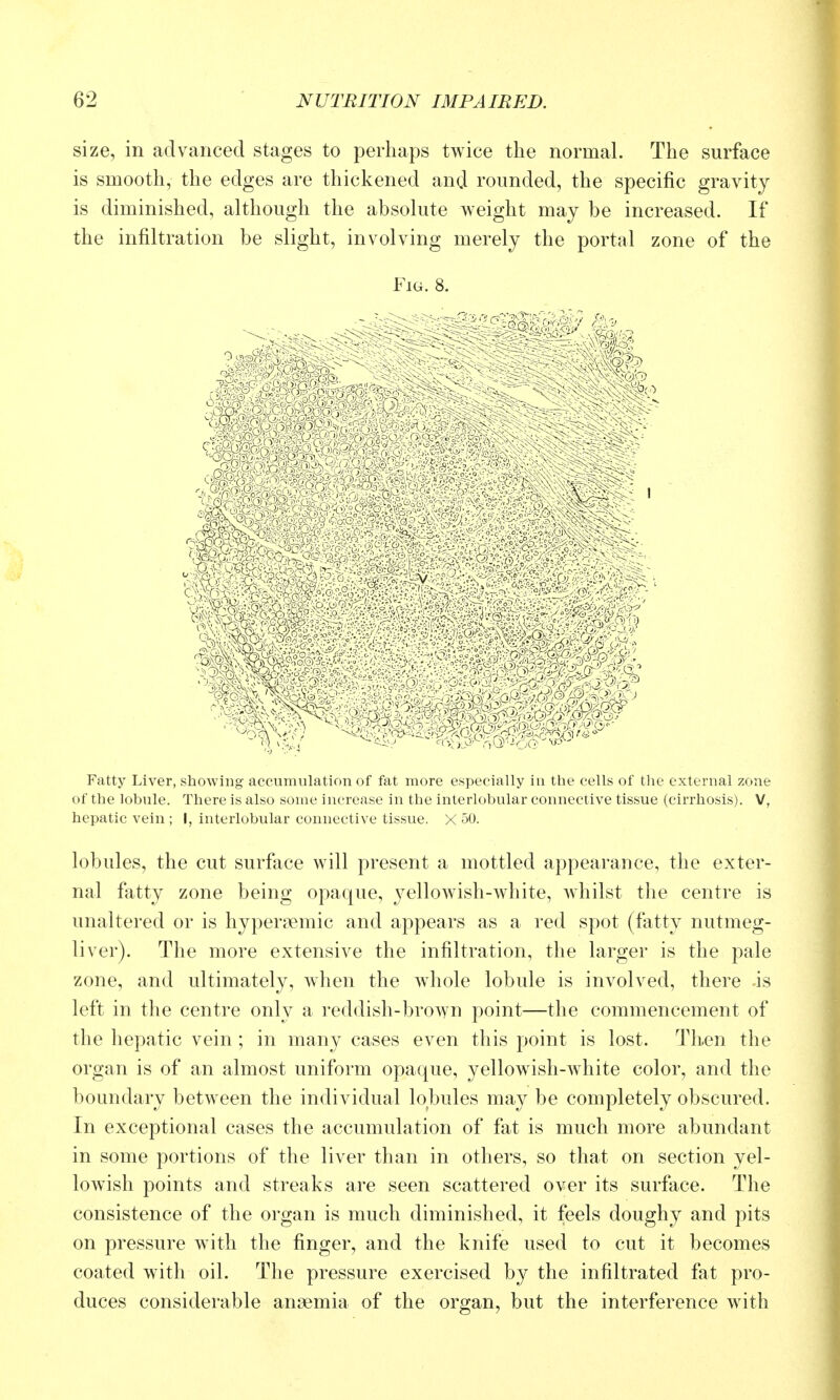 size, in advanced stages to perhaps twice the normal. The surface is smooth, the edges are thickened and rounded, the specific gravity is diminished, although the absolute weight may be increased. If the infiltration be slight, involving merely the portal zone of the Fig. 8. Fatty Liver, showing accumulation of fat more especially in the cells of the external zone of the lobule. There is also some increase in the interlobular connective tissue (cirrhosis). V, hepatic vein ; I, interlobular connective tissue. X 50. lobules, the cut surfiice will present a mottled appearance, the exter- nal fatty zone being opaque, j^ellowisli-wliite, whilst the centre is unaltered or is hyperaemic and appears as a red spot (fatty nutmeg- liver). The more extensive the infiltration, the larger is the pale zone, and ultimately, when the whole lobule is involved, there is left in the centre only a reddish-brown point—the commencement of the hepatic vein ; in many cases even this point is lost. Then the organ is of an almost uniform opaque, yellowish-white color, and the boundary between the individual lobules may be completely obscured. In exceptional cases the accumulation of fat is much more abundant in some portions of the liver than in others, so that on section yel- lowish points and streaks are seen scattered over its surface. The consistence of the organ is much diminished, it feels doughy and pits on pressure with the finger, and the knife used to cut it becomes coated with oil. The pressure exercised by the infiltrated fat pro- duces considerable ansemia of the organ, but the interference with