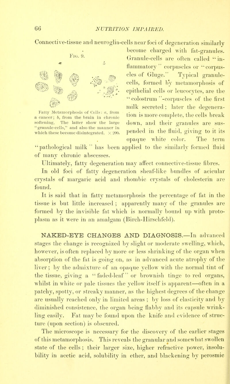 Connective-tissue and neuroglia-cells near foci of degeneration similarly become charged Avith fat-granules. Granule-cells are often called ''in- flammatory  corpuscles or corpus- cles of Gluge. Typical granule- cells, formed by metamorphosis of epithelial cells or leucocytes, are the '' colostrum -corpuscles of the first nnlk secreted ; later the degenera- tion is more complete, the cells break down, and their granules are sus- pended in the fluid, giving to it its opaque white color. The term pathological milk' has been applied to the similarly formed fluid of many chronic abscesses. Ultimately, fatty degeneration may affect connective-tissue fibres. In old foci of fatty degeneration sheaf-like bundles of acicular crystals of margaric acid and rhombic crystals of cholesterin are found. It is said that in fatty metamorphosis the percentage of fat in the tissue is but little increased ; apparently many of the granules are formed by the invisible fiit which is normally bound up with proto- plasm as it were in an amalgam (Birch-Hirschfeld). NAKED-EYE CHANGES AND DIAGNOSIS.—In advanced stages the change is recognized by slight or moderate swelling, which, however, is often replaced by more or less shrinking of the organ when absorption of the fiit is going on, as in advanced acute atrophy of the liver; by the admixture of an opaque yelloAv with the normal tint of the tissue, giving a  faded-leaf or brownish tinge to red organs, whilst in white or pale tissues the yellow itself is apparent—often in a patchy, spotty, or streaky manner, as the highest degrees of the change are usually reached only in limited areas ; by loss of elasticity and by diminished consistence, the organ being flabby and its capsule wrink- ling easily. Fat may be found upon the knife and evidence of struc- ture (upon section) is obscured. The microscope is necessary for the discovery of the earlier stages of this metamorphosis. This reveals the granular and somewhat swollen state of the cells ; their larger size, higher refractive poAver, insolu- bility in acetic acid, solubility in ether, and blackening by perosmic Fig. 9. Fatty Metamorphosis of Cells: a, from a cancer; b, from the brain in chronic softening, The latter show the large granule-cells, and also the manner in which these become disintegrated. X 200.