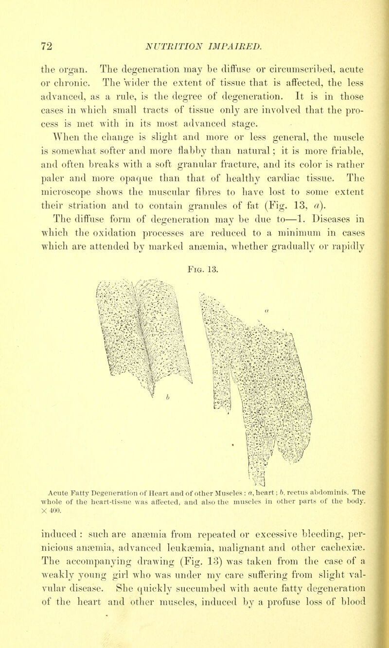 the organ. The degeneration may be diffuse or circumscribed, acute or chronic. The wider the extent of tissue that is affected, the less advanced, as a rule, is the degree of degeneration. It is in those cases in which small tracts of tissue only are involved that the pro- cess is met with in its most advanced stage. When the change is slight and more or less general, the muscle is somewhat softer and more flabby than natural; it is more friable, and often breaks with a soft granular fracture, and its color is rather paler and more opaque than that of healthy cardiac tissue. The microscope shows the muscular fibres to have lost to some extent their striation and to contain granules of fat (Fig. 13, a). The diffuse form of degeneration may be due to—1. Diseases in which the oxidation processes are reduced to a minimum in cases which are attended by marked anaemia, whether gradually or rapidly Fig. 13. Acute Fatty Degeneration of Heart and of other Muscles : a, heart; h, rectus abdominis. The whole of the heart-tissue was affected, and also the muscles in other parts of the body. X 400. induced : such are ansemia from repeated or excessive bleeding, per- nicious anaemia, advanced leukaemia, malignant and other cachexias. The accompanying drawing (Fig. 13) was taken from the case of a weakly young girl who was under my care suffering from slight val- vular disease. She quickly succumbed with acute fatty degeneration of the heart and other muscles, induced by a profuse loss of blood