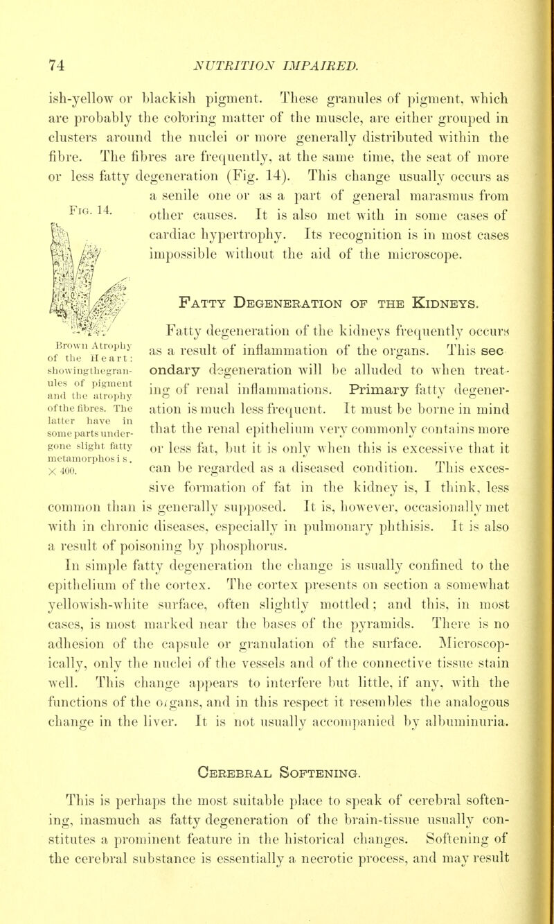 ish-yellow or blackish pigment. These granules of pigment, which are probably the col'oring matter of the muscle, are either grouped in clusters around the nuclei or more generally distributed within the fibre. The fibres are frequently, at the same time, the seat of more or less fatty degeneration (Fig. 14). This change usually occurs as a senile one or as a part of general marasmus from other causes. It is also met with in some cases of cardiac hypertrophy. Its recognition is in most cases impossible without the aid of the microscope. Fatty Degeneration of the Kidneys. Fatty degeneration of the kidneys frequently occuri'< as a result of inflammation of the organs. This sec ondary degeneration will be alluded to Avhen treat- ing of renal inflammations. Primary flitty degener- ation is much less frequent. It must be borne in mind that the renal epithelium very commonly contains more or less fat, but it is only when this is excessive that it can be regarded as a diseased condition. This exces- sive formation of fat in the kidney is, I think, less common than is generally supposed. It is, however, occasionally met with in chronic diseases, especially in pulmonary phthisis. It is also a result of poisoning by phosphorus. In simple fatty degeneration the change is usually confined to the epithelium of the cortex. The cortex presents on section a somewhat yellowish-white surfiice, often slightly mottled; and this, in most cases, is most marked near the bases of the pyramids. There is no adhesion of the capsule or granulation of the surface. Microscop- ically, only the nuclei of the vessels and of the connective tissue stain well. This change appears to interfere but little, if any, with the functions of the oigans, and in this respect it resembles the analogous change in the liver. It is not usually accompanied by albuminuria. Cerebral Softening. This is perhaps the most suitable place to speak of cerebral soften- ing, inasmuch as fatty degeneration of the brain-tissue usually con- stitutes a prominent feature in the historical changes. Softening of the cerebral substance is essentially a necrotic process, and may result Fig. 14. mm . .. Brown Atrophy of the Heart: showingthegran- ules of pigment and the atrophy of the fibres. The latter have in some parts under- gone slight fatty metamorphosi s. X 400.