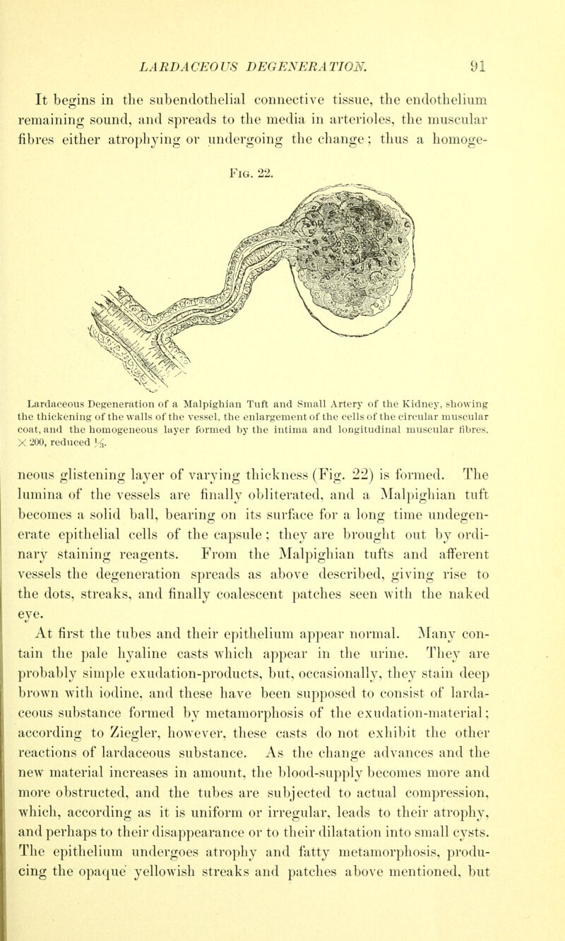 It begins in the subendothelial connective tissue, the endothelium remaining sound, and spreads to the media in arterioles, the muscular fibres either atrophying or undergoing the change; thus a homoge- FiG. 22. Lardaceous Degeneration of a Malpighian Tuft and Small Artery of the Kidney, showing the thickening of the walls of the vessel, the enlargement of the cells of the circular muscular coat, and the homogeneous layer formed by the intima and longitudinal muscular fibres. X 200, reduced Y^. neous glistening layer of varying thickness (Fig. 22) is formed. The lumina of the vessels are finally obliterated, and a Malpighian tuft becomes a solid ball, bearino; on its surfiice for a lono; time undegen- erate epithelial cells of the capsule; they are brought out by ordi- nary staining reagents. From the Malpighian tufts and afferent vessels the degeneration spreads as above described, giving rise to the dots, streaks, and finally coalescent patches seen with the naked eye. At first the tubes and their epithelium appear normal. ^lany con- tain the pale hyaline casts which appear in the urine. They are probably simple exudation-products, but, occasionally, they stain deep brown with iodine, and these have been supposed to consist of larda- ceous substance formed by metamorphosis of the exudation-material; according to Ziegler, however, these casts do not exhibit the other reactions of lardaceous substance. As the change advances and the new material increases in amount, the blood-supply becomes more and more obstructed, and the tubes are subjected to actual compression, which, according as it is uniform or irregular, leads to their atrophy, and perhaps to their disappearance or to their dilatation into small cysts. The epithelium undergoes atrophy and fatty metamorphosis, produ- cing the opaque yellowish streaks and patches above mentioned, but
