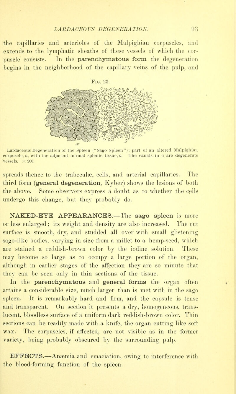 the capillaries and arterioles of the Malpighian corpuscles, and extends to the lymphatic sheaths of these vessels of which the cor- puscle consists. In the parenchymatous form the degeneration begins in the neighborhood of the capillary veins of the pulp, and Fig. 23. Lardaceous Degeneration of the Spleen (Sago Spleen): part of an altered Malpigbiar. corpuscle, a, with the adjacent normal splenic tissue, b. The canals in a are degenerate vessels. X 200. spreads thence to the trabeculie, cells, and arterial capillaries. The third form (g-eneral degeneration, Kyber) shows the lesions of both the above. Some observers express a doubt as to whether the cells undergo this change, but they probably do. NAKED-EYE APPEARANCES.—The sago spleen is more or less enlarged ; its weight and density are also increased. The cut surface is smooth, dry, and studded all over with small glistening sago-like bodies, varying in size from a millet to a hemp-seed, which are stained a reddish-brown color by the iodine solution. These may become so large as to occupy a large portion of the organ, although in earlier stages of the affection they are so minute that they can be seen only in thin sections of the tissue. In the parenchymatous and general forms the organ often attains a considerable size, much larger than is met with in the sao;o spleen. It is remarkably hard and firm, and the capsule is tense and transparent. On section it presents a dry, homogeneous, trans- lucent, bloodless surface of a uniform dark reddish-brown color. Thin sections can be readily made wdth a knife, the organ cutting like soft wax. The corpuscles, if affected, are not visible as in the former variety, being probably obscured by the surrounding pulp. EFFECTS.—Anaemia and emaciation, owing to interference with the blood-forming function of the spleen.