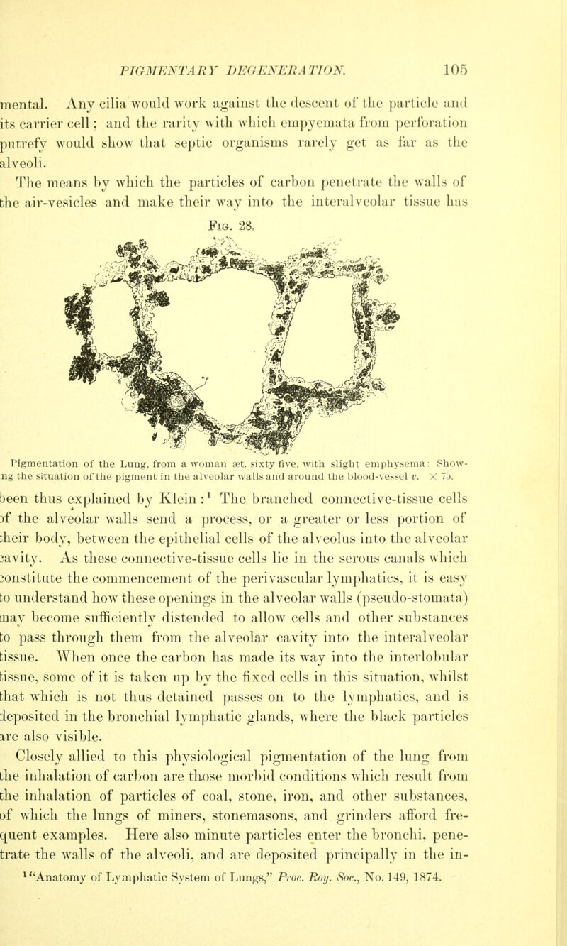 mental. Any cilia would Avork against the descent of the particle and its carrier cell; and the rarity with which empyemata from perforation putrefy would show that septic organisms rarely get as far as the alveoli. The means by which the particles of carbon penetrate the walls of the air-vesicles and make their way into the interalveolar tissue has Fig. 28, Pigmentation of the Lung, from a woman set sixty five, with slight emphysema: Show- ng the situation of the pigment in the alveolar walls and around the blood-vessel v. X 75. been thus explained by Klein: ^ The branched connective-tissue cells )f the alveolar walls send a process, or a greater or less portion of :heir body, between the epithelial cells of the alveolus into the alveolar 3avity. As these connective-tissue cells lie in the serous canals which 3onstitute the commencement of the perivascular lymphatics, it is easy to understand how these openings in the alveolar walls (pseudo-stomata) oaay become sufficiently distended to allow cells and other substances to pass through them from the alveolar cavity into the interalveolar tissue. When once the carbon has made its way into the interlobular tissue, some of it is taken up by the fixed cells in this situation, whilst that which is not thus detained passes on to the lymphatics, and is ieposited in the bronchial lymphatic glands, where the black particles ire also visible. Closely allied to this physiological pigmentation of the lung from the inhalation of carbon are those morbid conditions which result from the inhalation of particles of coal, stone, iron, and other substances, of which the lungs of miners, stonemasons, and grinders afford fre- quent examples. Here also minute particles enter the bronchi, pene- trate the walls of the alveoli, and are deposited principally in the in- ^ Anatomy of Lymphatic System of Lungs, Proc. Roy. Soc, No. 149, 1874.