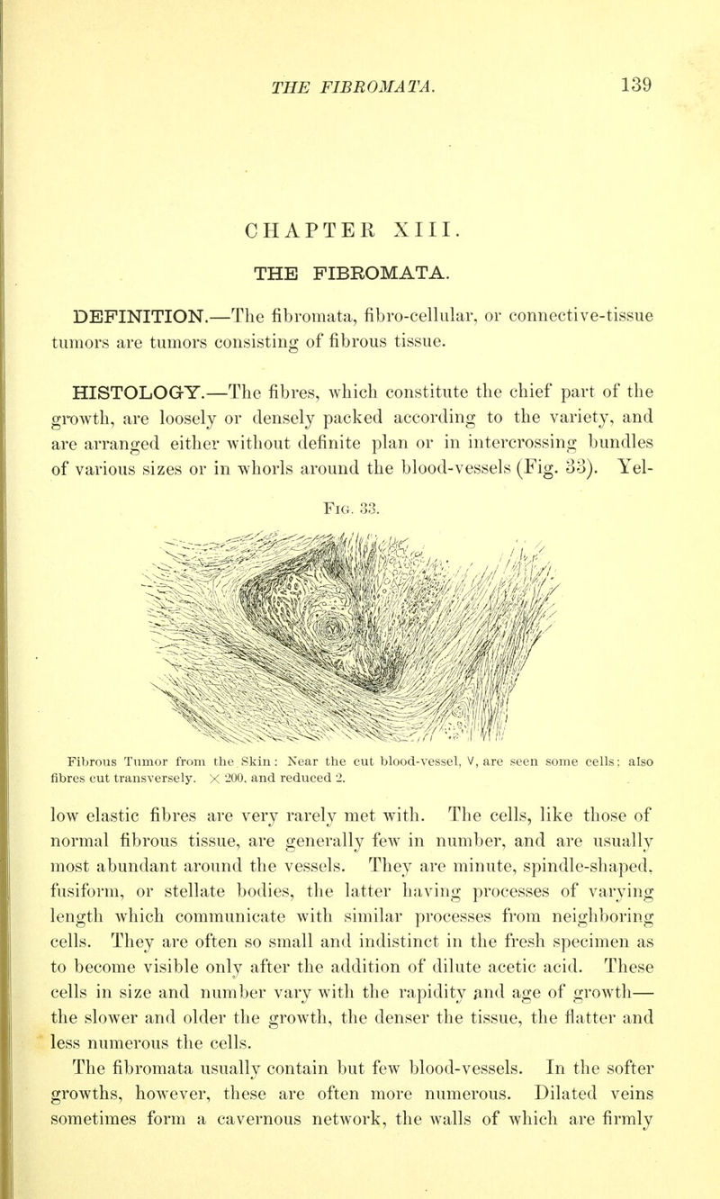 CHAPTER XIII. THE FIBROMATA. DEFINITION.—The fibromata, fibro-celliilar, or connective-tissue tumors are tumors consisting of fibrous tissue. HISTOLOGY.—The fibres, which constitute the chief part of the growth, are loosely or densely packed according to the variety, and are arranged either without definite plan or in intercrossing bundles of various sizes or in whorls around the blood-vessels (Fig. 33). Yel- FiG. 33. Fibrous Tumor from the.Skin: Near the cut blood-vessel, V, are seen some cells: also fibres cut transversely. X 200, and reduced 2. low elastic fibres are very rarely met with. The cells, like those of normal fibrous tissue, are generally few in number, and are usually most abundant around the vessels. They are minute, spindle-shaped, fusiform, or stellate bodies, the latter having processes of varying length which communicate with similar processes from neighboring cells. They are often so small and indistinct in the fresh specimen as to become visible only after the addition of dilute acetic acid. These cells in size and number vary with the rapidity ^ind age of growth— the slower and older the growth, the denser the tissue, the flatter and less numerous the cells. The fibromata usually contain but few blood-vessels. In the softer growths, however, these are often more numerous. Dilated veins sometimes form a cavernous network, the walls of which are firmly
