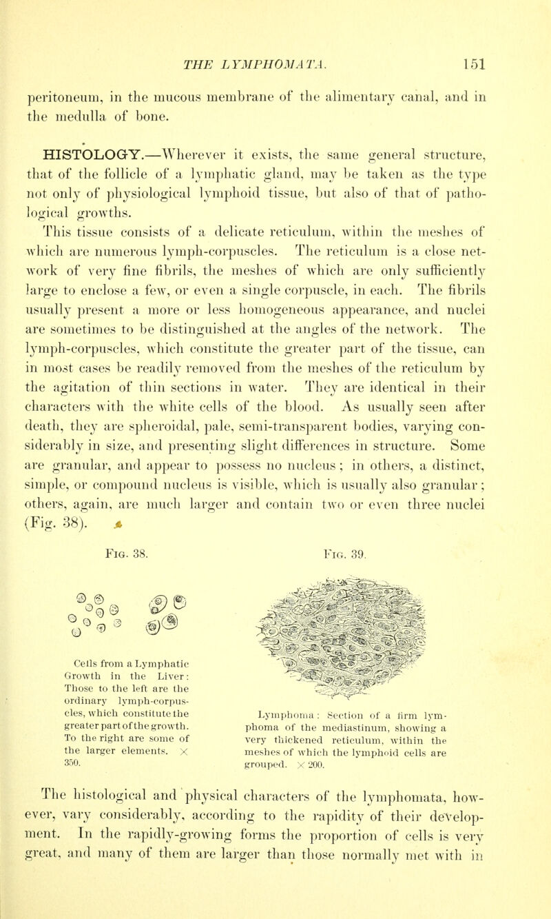peritoneum, in the mucous membrane of the alimentary canal, and in the medulla of bone. HISTOLOGY.—Wherever it exists, the same general structure, that of the follicle of a lymphatic gland, may be taken as the type not only of physiological lymphoid tissue, but also of that of patho- loo-ical growths. This tissue consists of a delicate reticulum, within the meshes of which are numerous lymph-corpuscles. The reticulum is a close net- work of very fine fibrils, the meshes of which are only sufficiently^ large to enclose a fcAV, or even a single corpuscle, in each. The fibrils usually present a more or less homogeneous appearance, and nuclei are sometimes to be distinguished at the angles of the network. The lymph-corpuscles, which constitute the greater part of the tissue, can in most cases be readily removed from the meshes of the reticulum by the agitation of thin sections in water. They are identical in their characters with the white cells of the blood. As usually seen after death, they are spheroidal, pale, semi-transparent bodies, varying con- siderably in size, and presenting slight differences in structure. Some are granular, and appear to possess no nucleus ; in others, a distinct, simple, or compound nucleus is visible, which is usually also granular; others, again, are much larger and contain two or even three nuclei (Fig. 38). Fig. 38. Fig. 39. Cells from a Lymphatic Growth in the Liver: Those to the left are the ordinary lymph-corpus- cles, which constitute the greater part of the growth. To the right are some of the larger elements, x 350. Lymphoma : Section of a tirm lym- phoma of the mediastinum, showing a very thickened reticulum, within the meshes of Avhich the lymphoid cells are grouped. X 200. The histological and physical characters of the lymphomata, how- ever, vary considerably, according to the rapidity of their develop- ment. In the rapidly-growing forms the proportion of cells is very great, and many of them are larger than those normally met with in